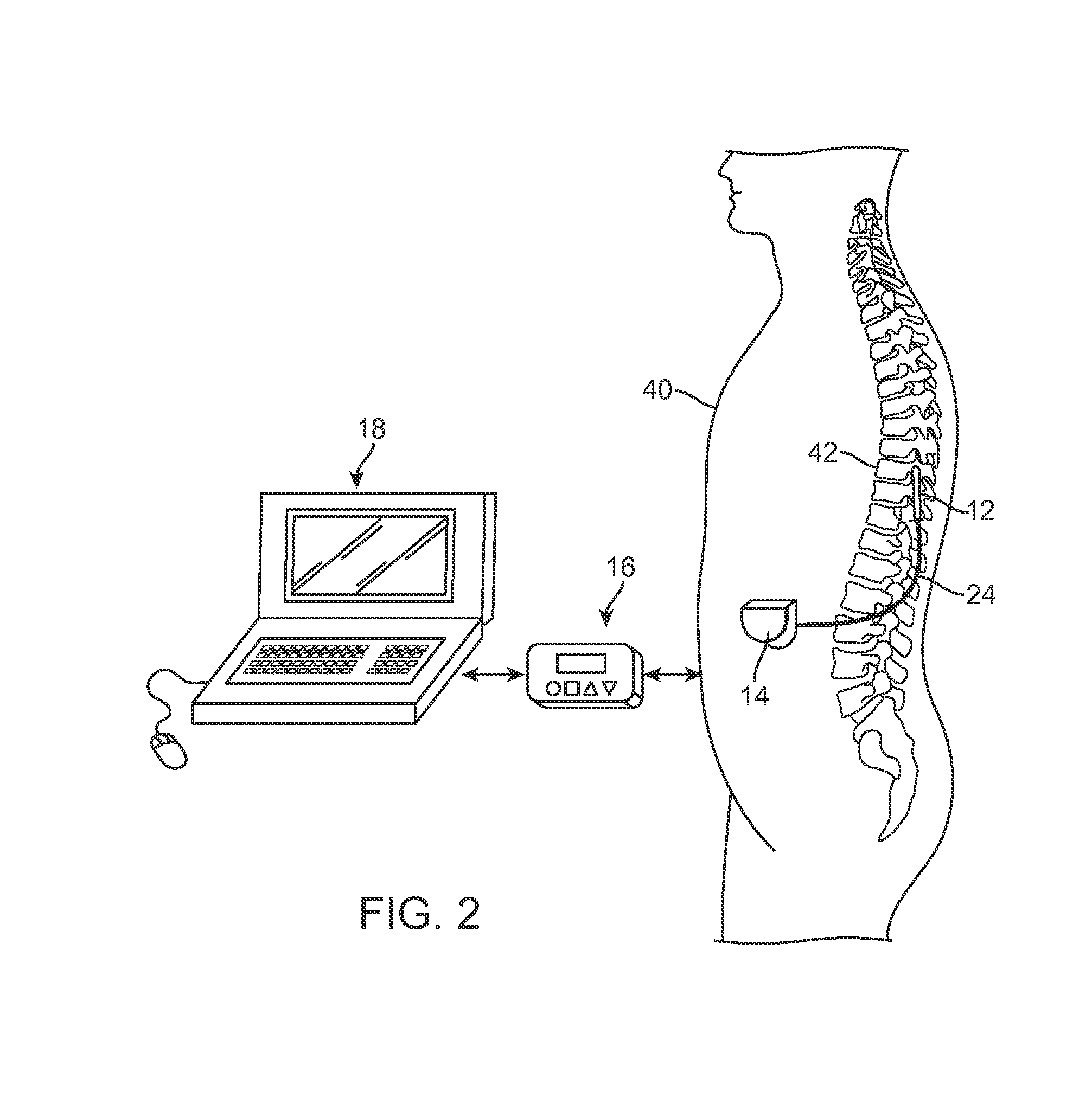 System and method for delivering modulated sub-threshold therapy to a patient