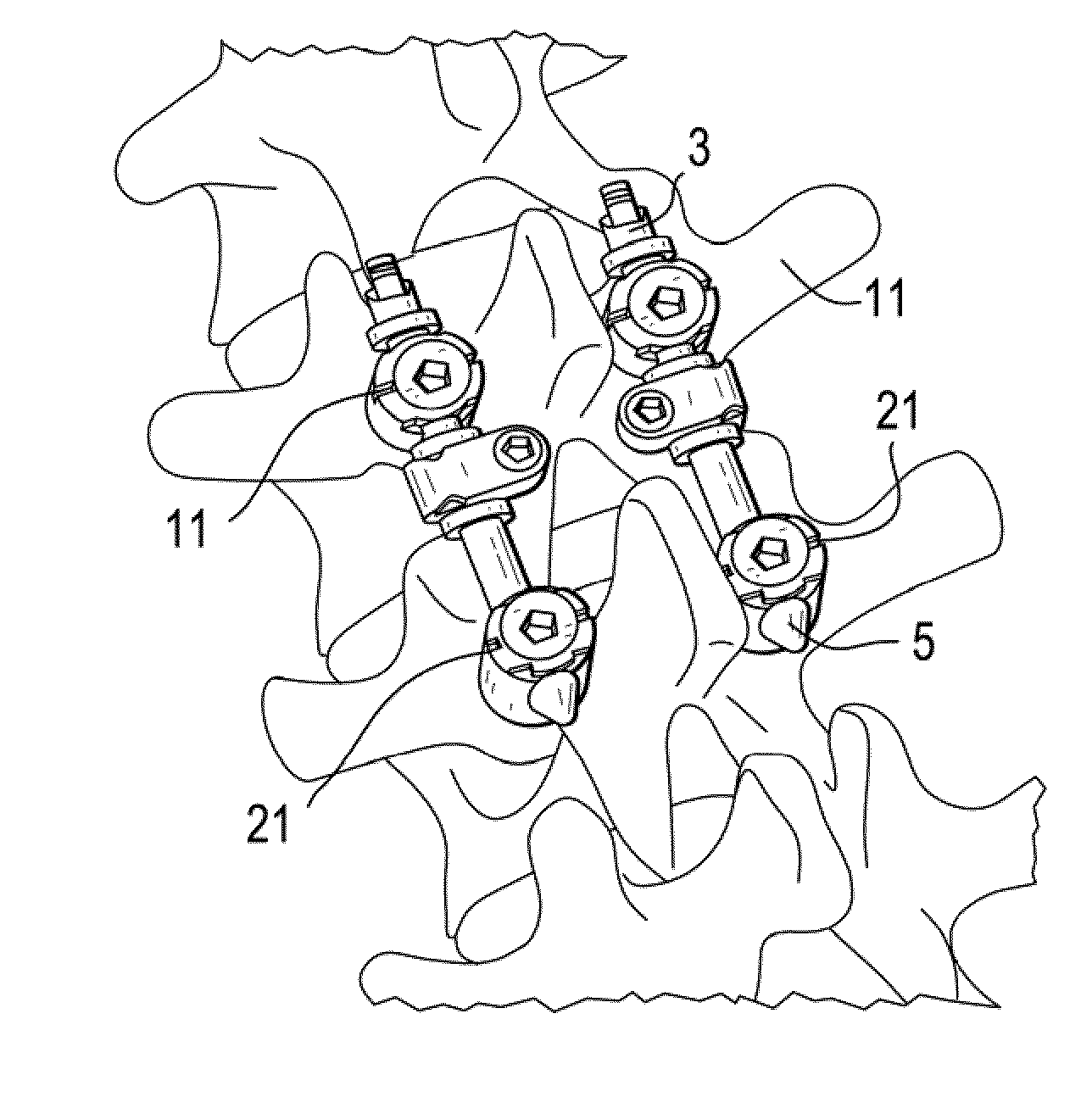 Posterior Dynamic Stabilization Device Having A Mobile Anchor