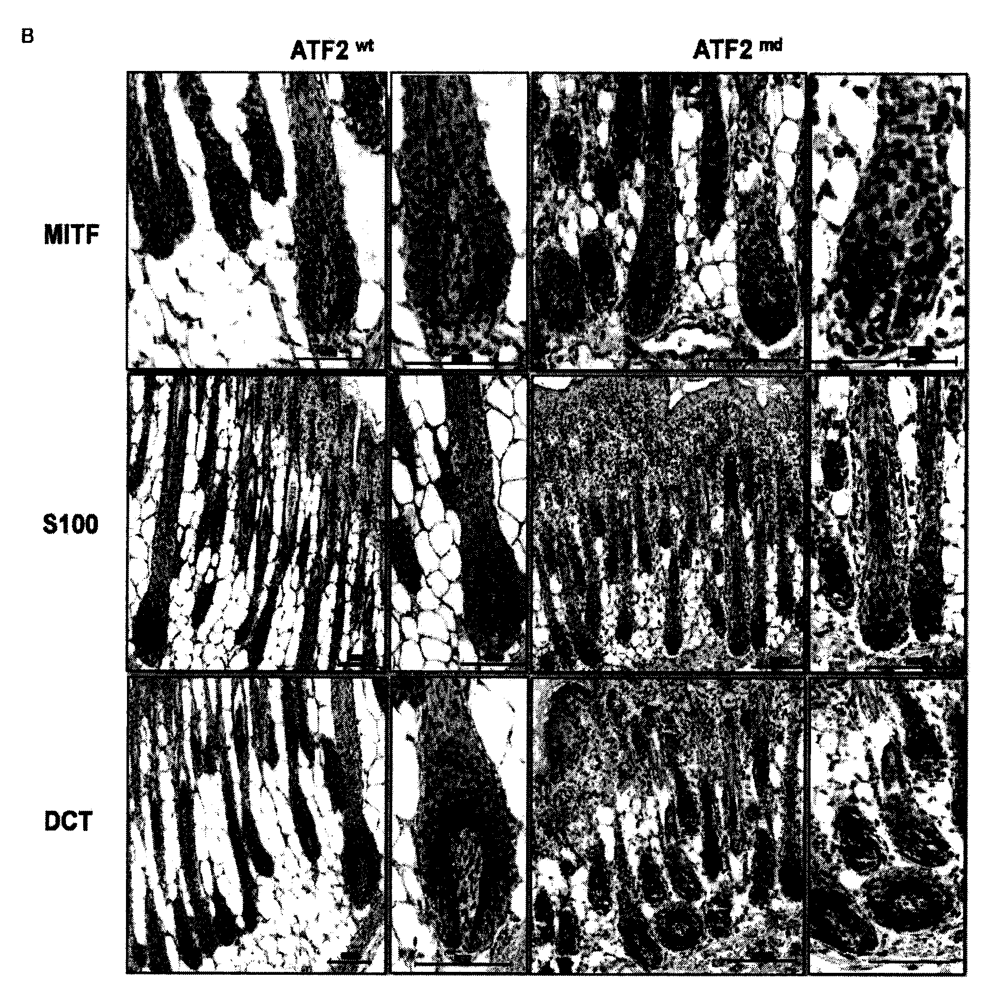 Methods of diagnosis and treatment of melanoma