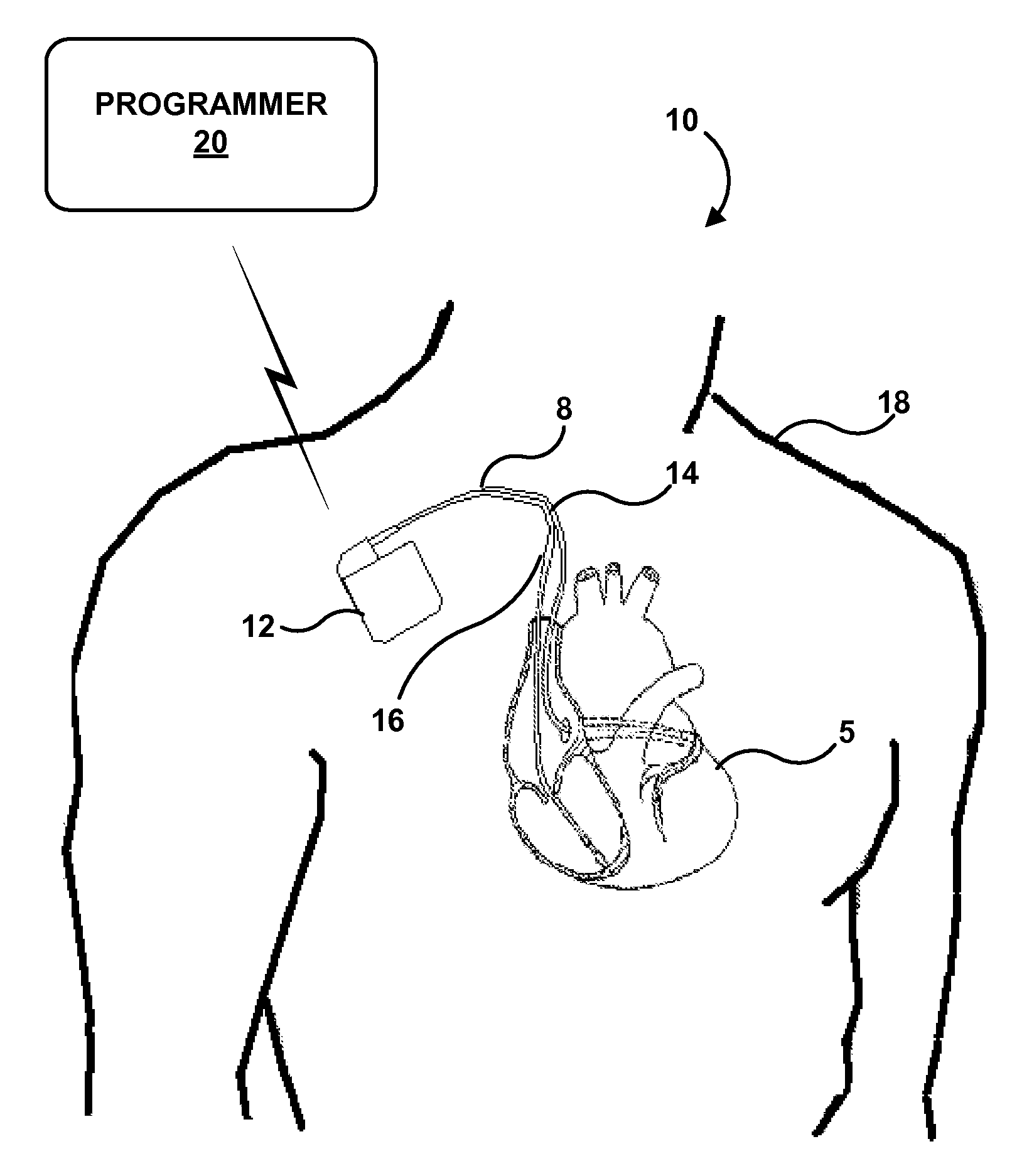 Electrode configurations for directional leads