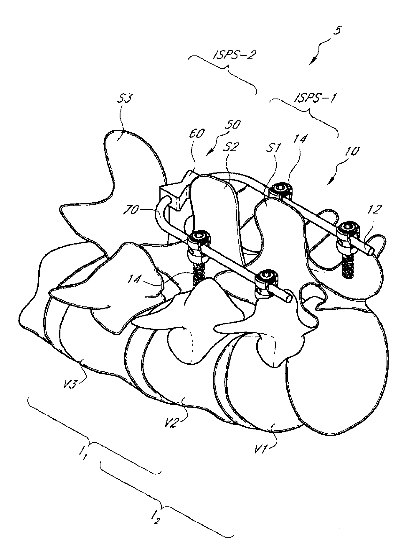 Systems and methods for reducing adjacent level disc disease