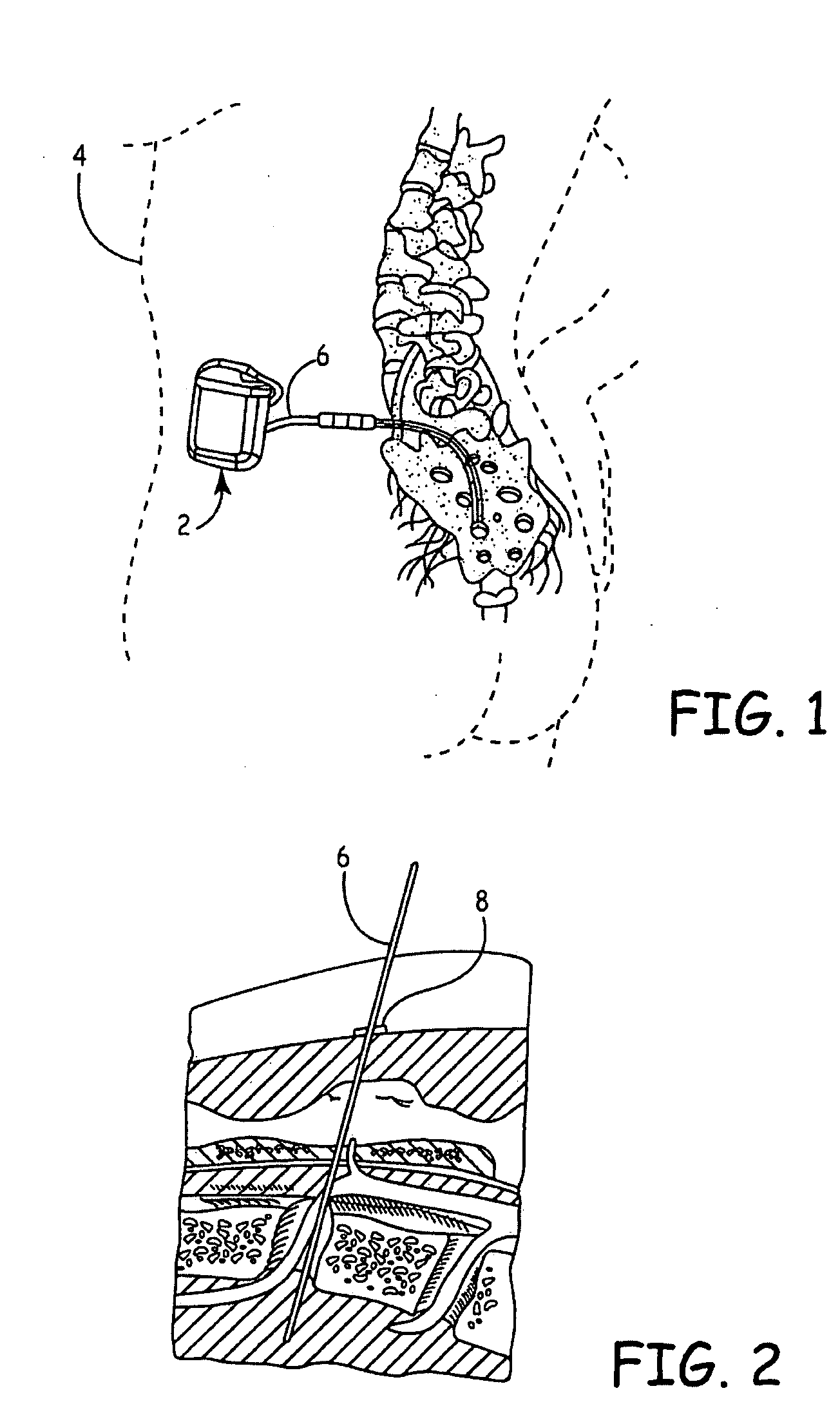 Anchor having fill port for use with an implantable therapy delivery element