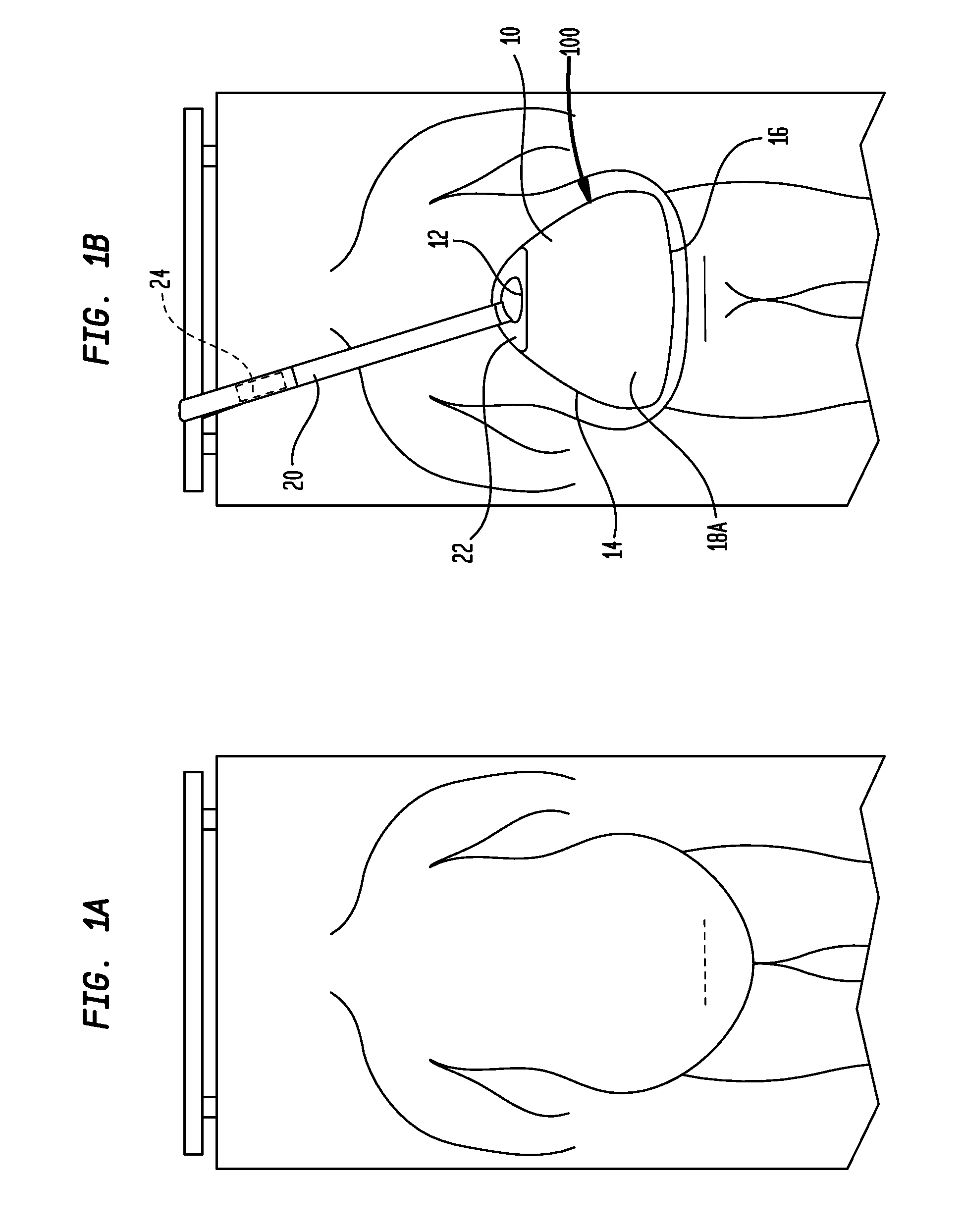 Abdominal Elevator