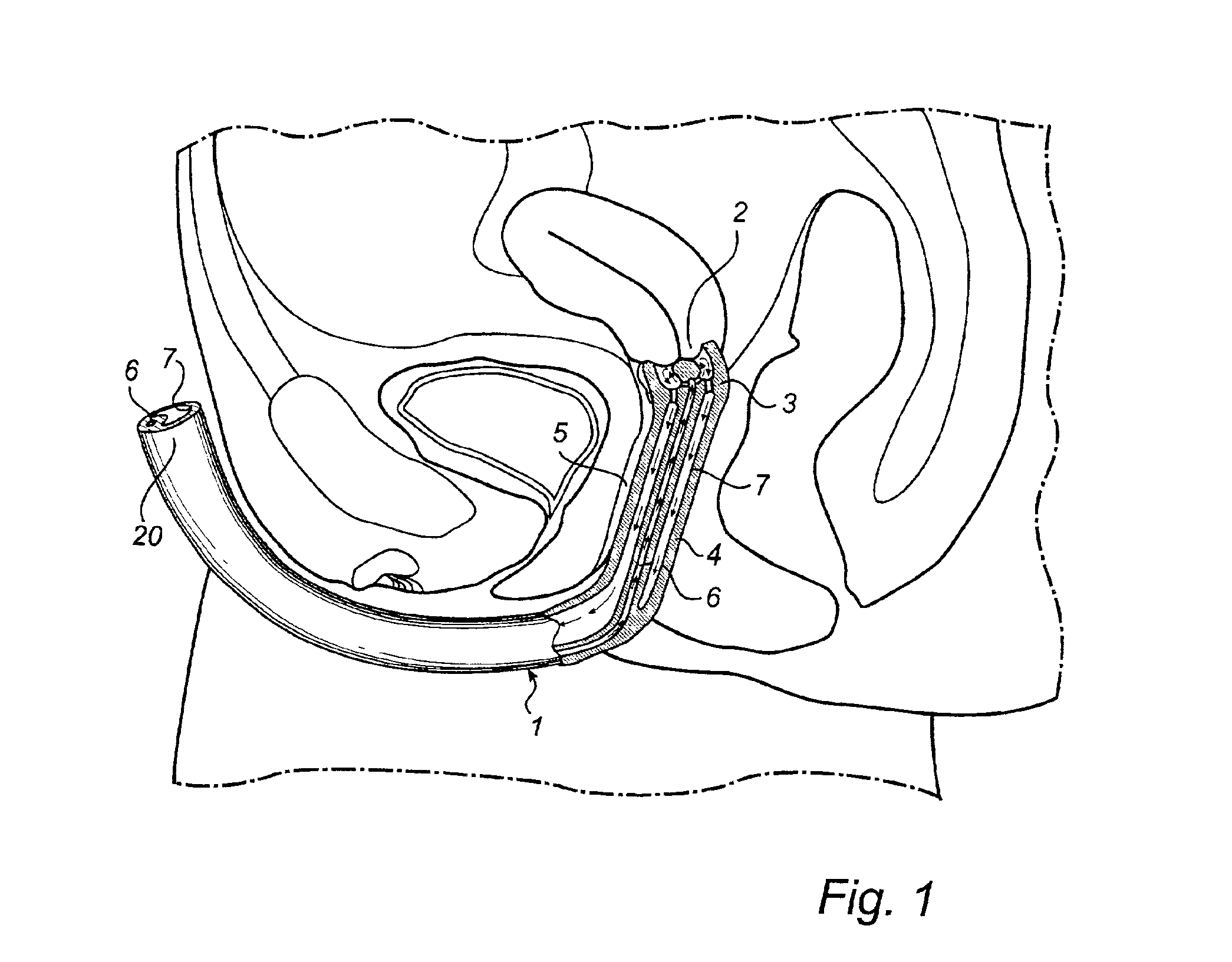 Method and device for treating inter alia the cervix