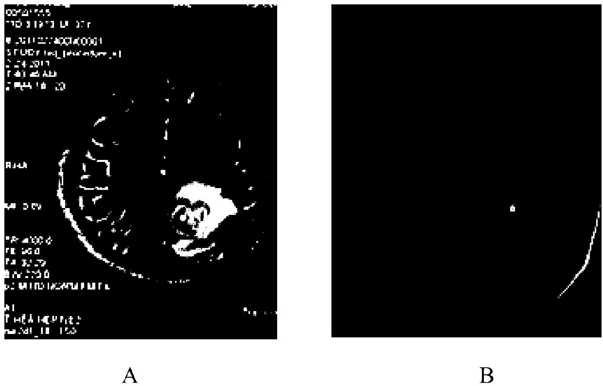 Drug-resistant glioblastoma cell line of primary temozolomide and bevacizumab, construction method and application of cell line