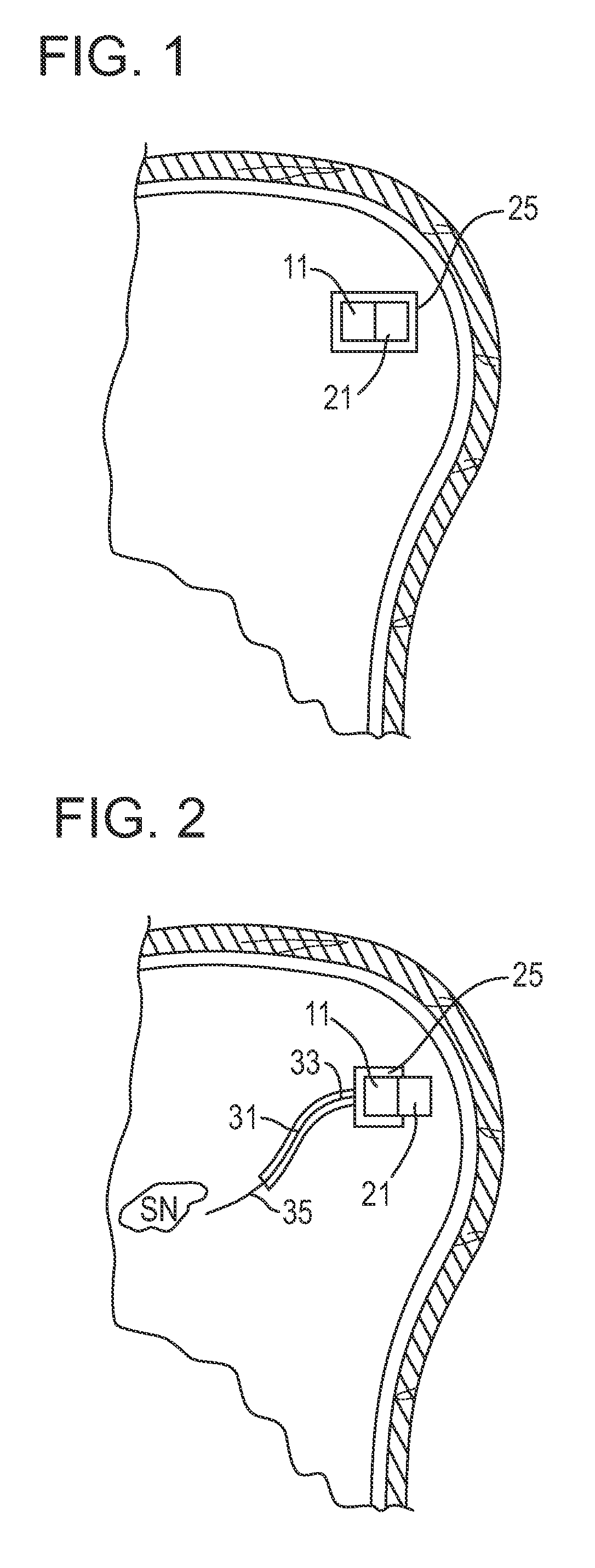 Endoscopic delivery of red/NIR light to the subventricular zone