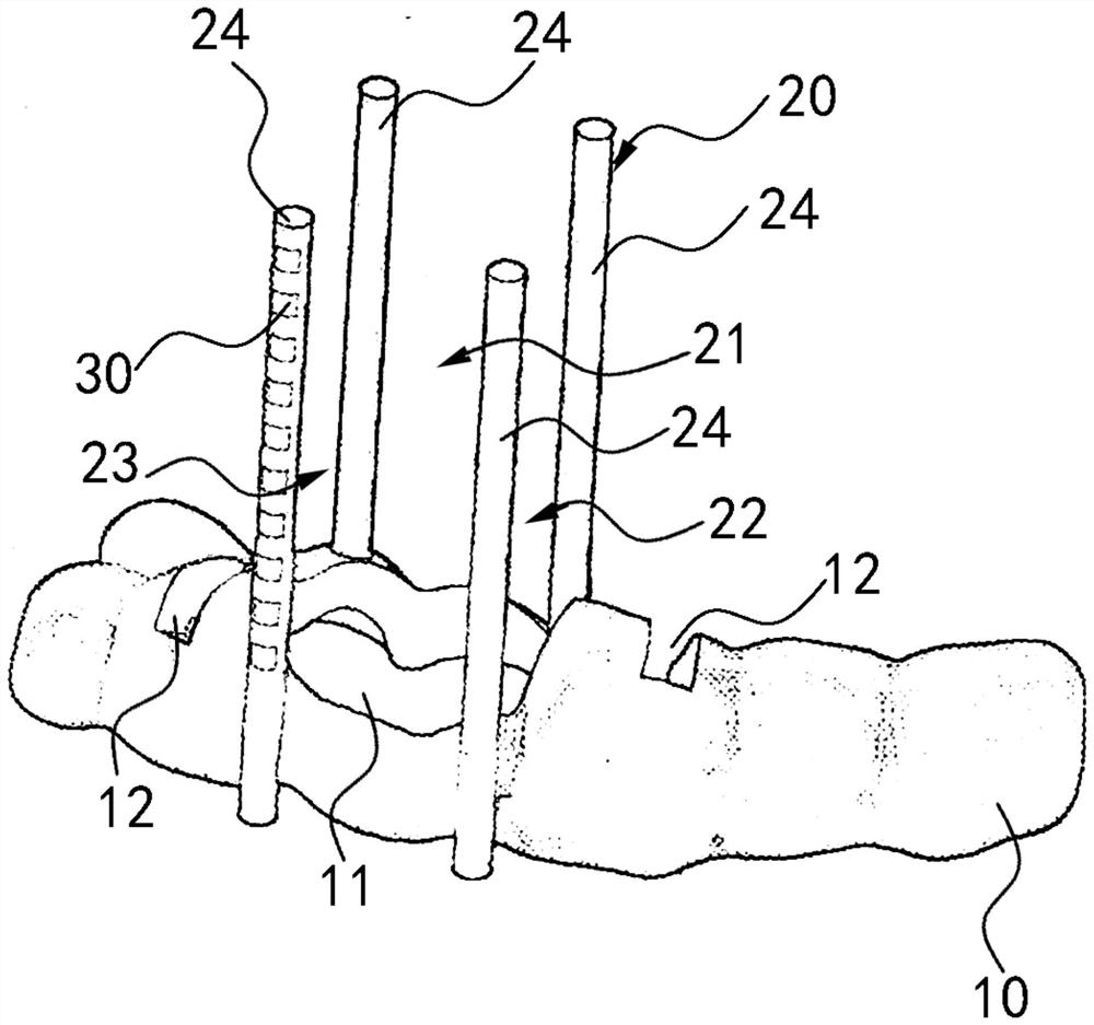 Dental stake removal guide plate, system and design and manufacturing method of dental stake removal guide plate