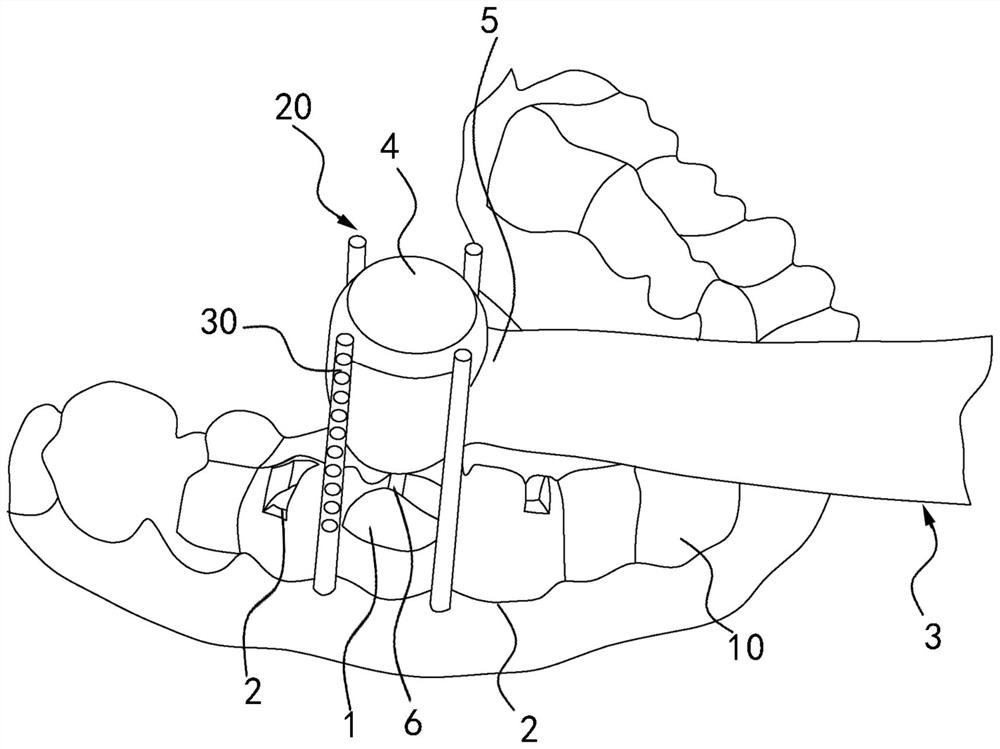 Dental stake removal guide plate, system and design and manufacturing method of dental stake removal guide plate