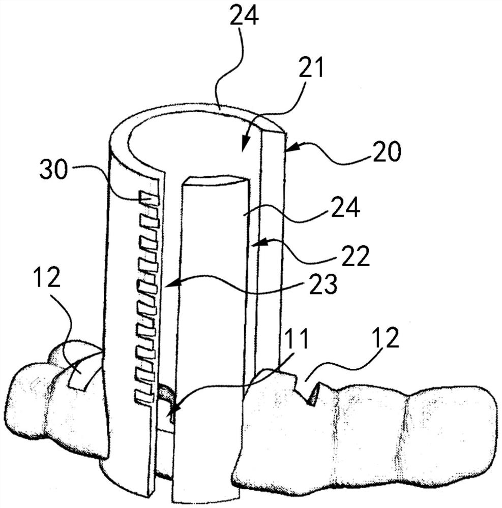 Dental stake removal guide plate, system and design and manufacturing method of dental stake removal guide plate