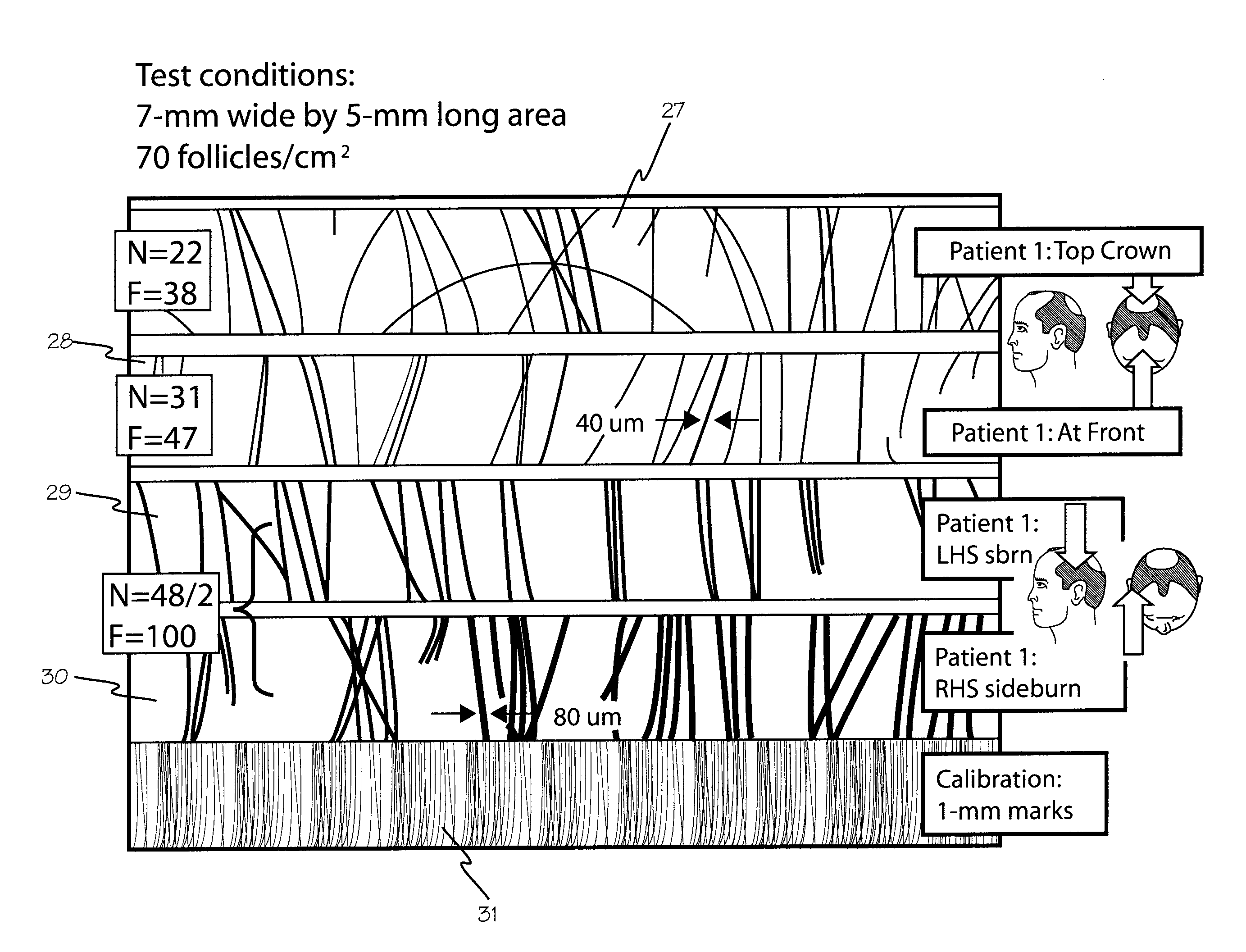 Hair Densitometer