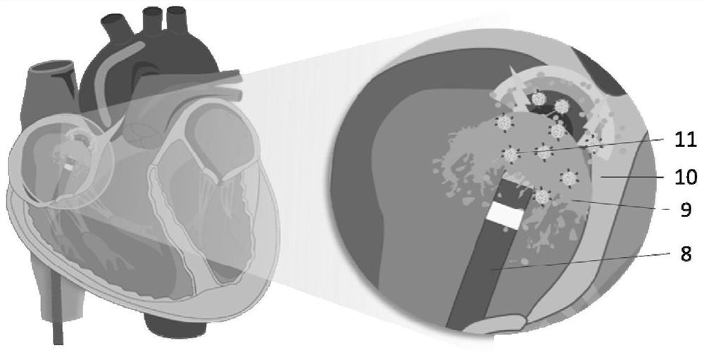 A locally deliverable nano-preparation for inhibiting inflammation of radiofrequency ablation cardiac tissue, its preparation method and application