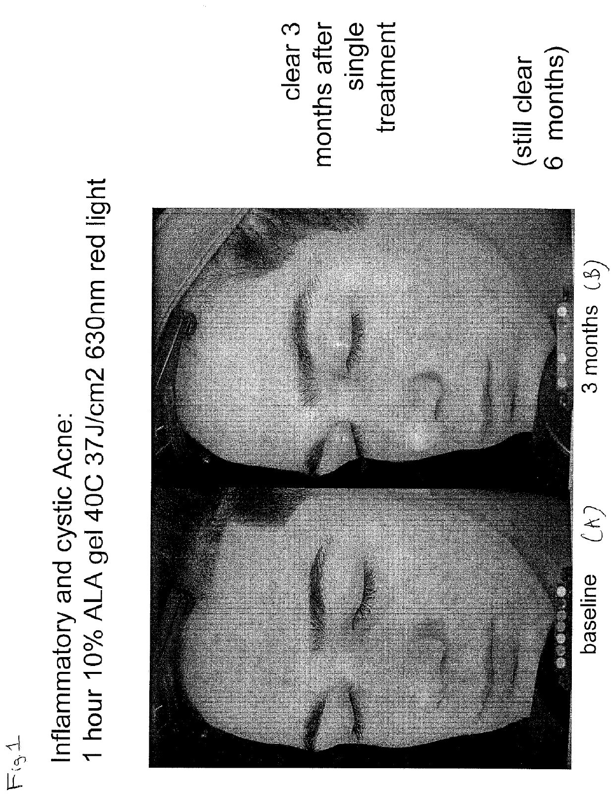 Photodynamic Therapy Method for Skin Disorders