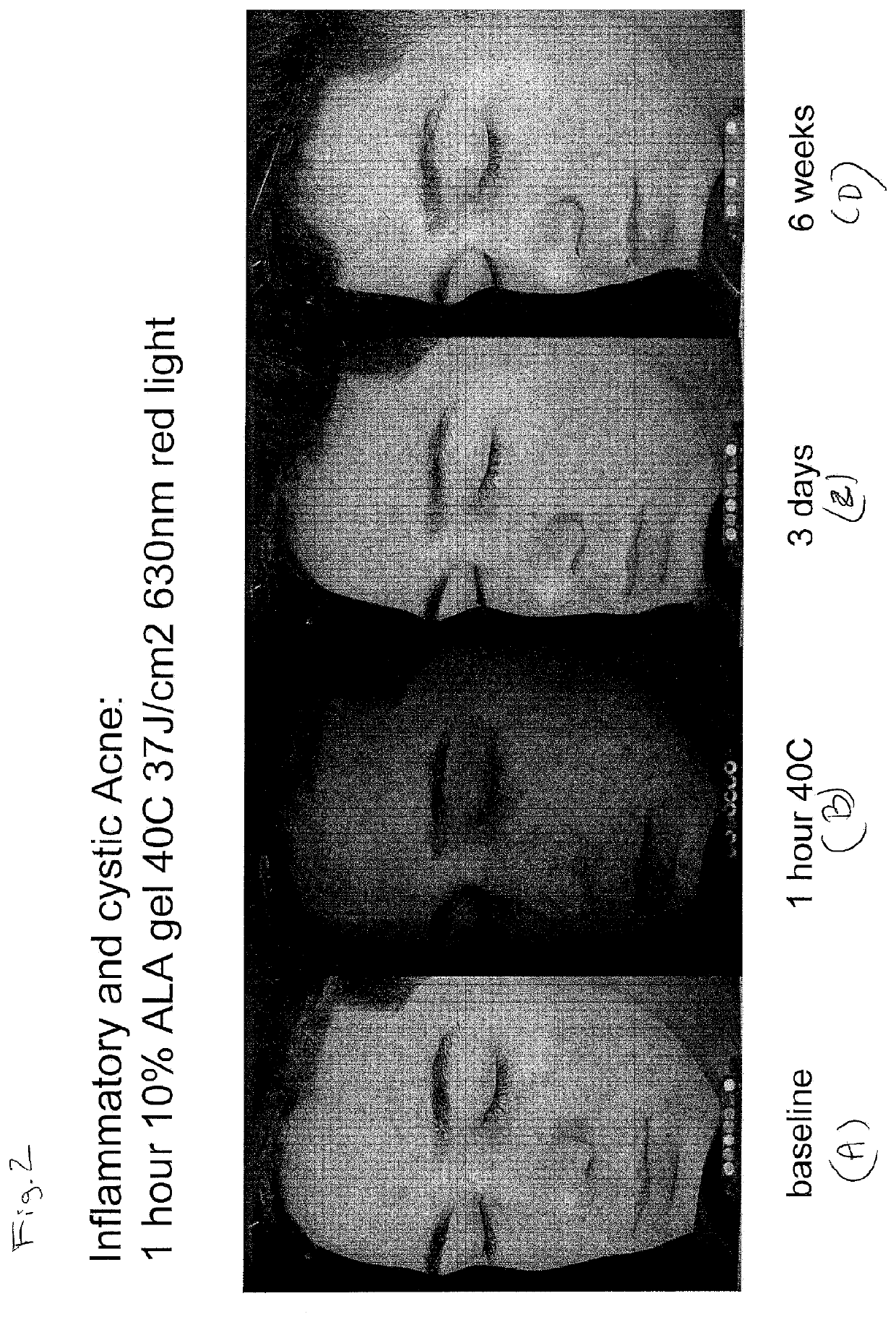 Photodynamic Therapy Method for Skin Disorders