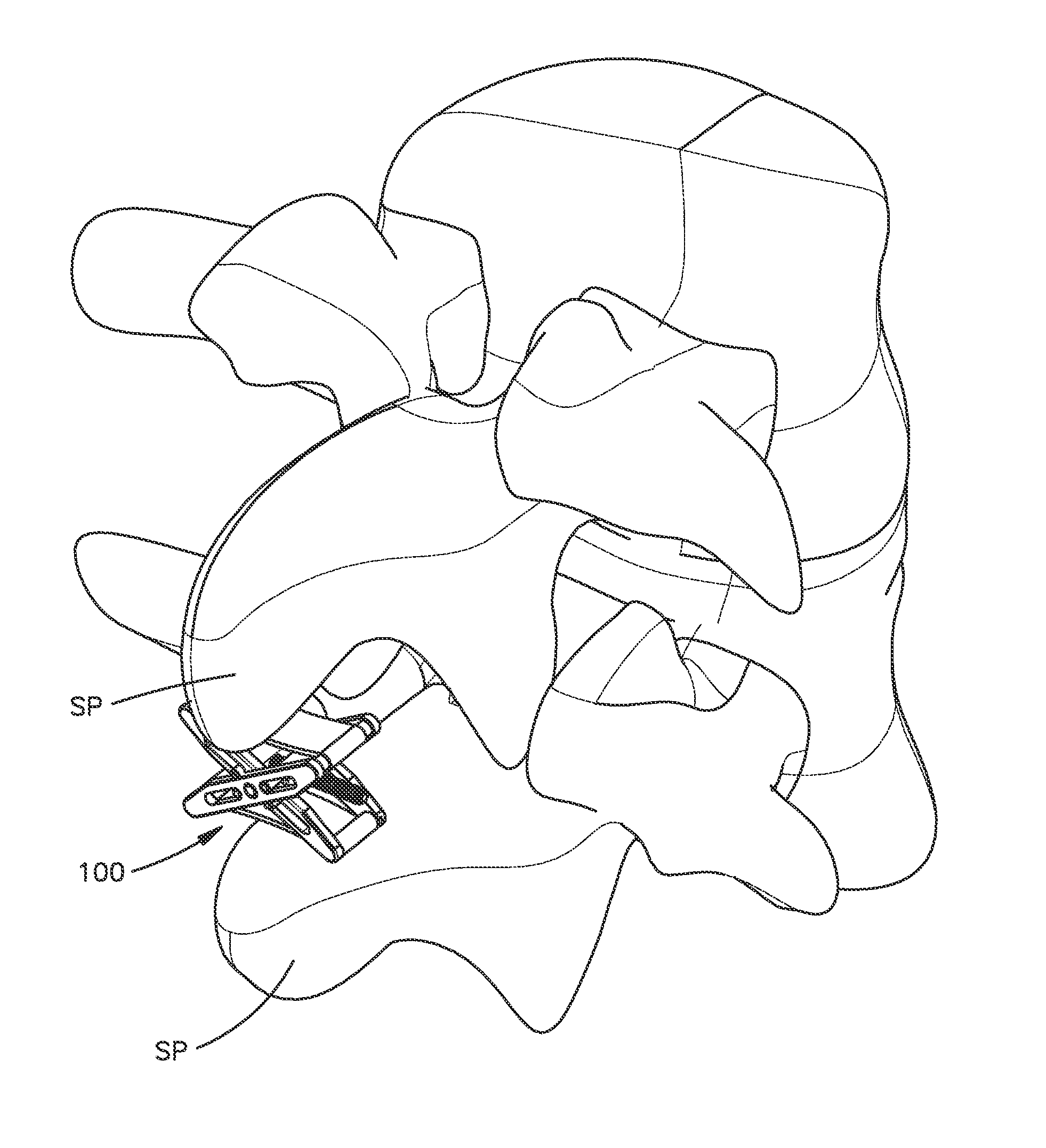 Expandable interspinous process spacer