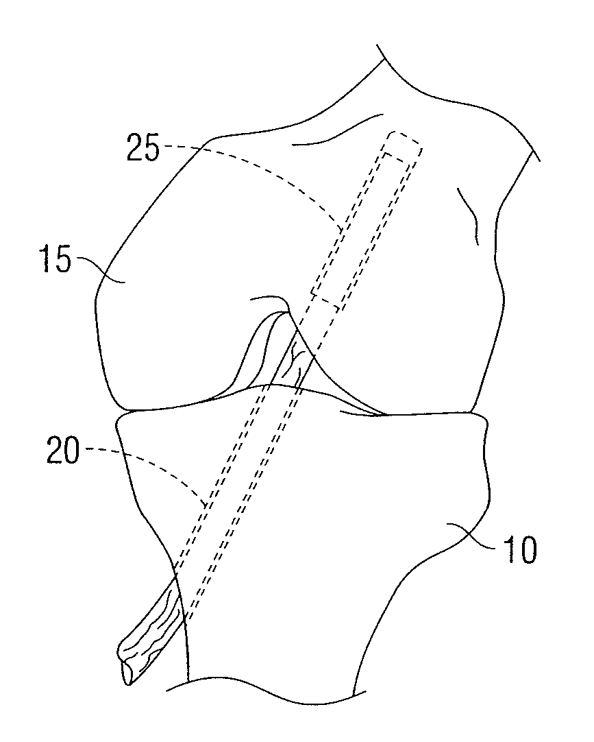 Femoral guide for acl repair having multiple lumen