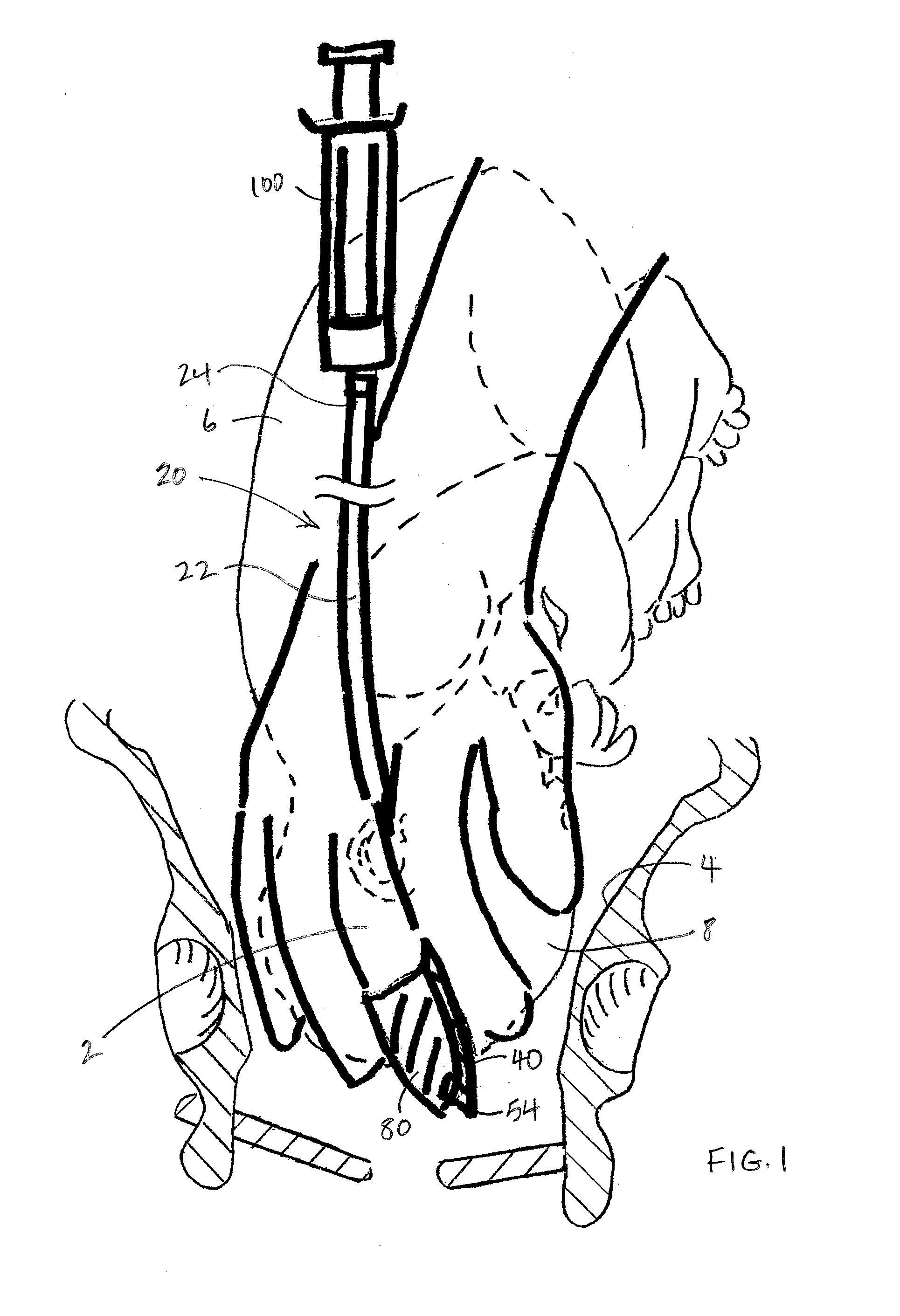 Device for assisting cesarean deliveries