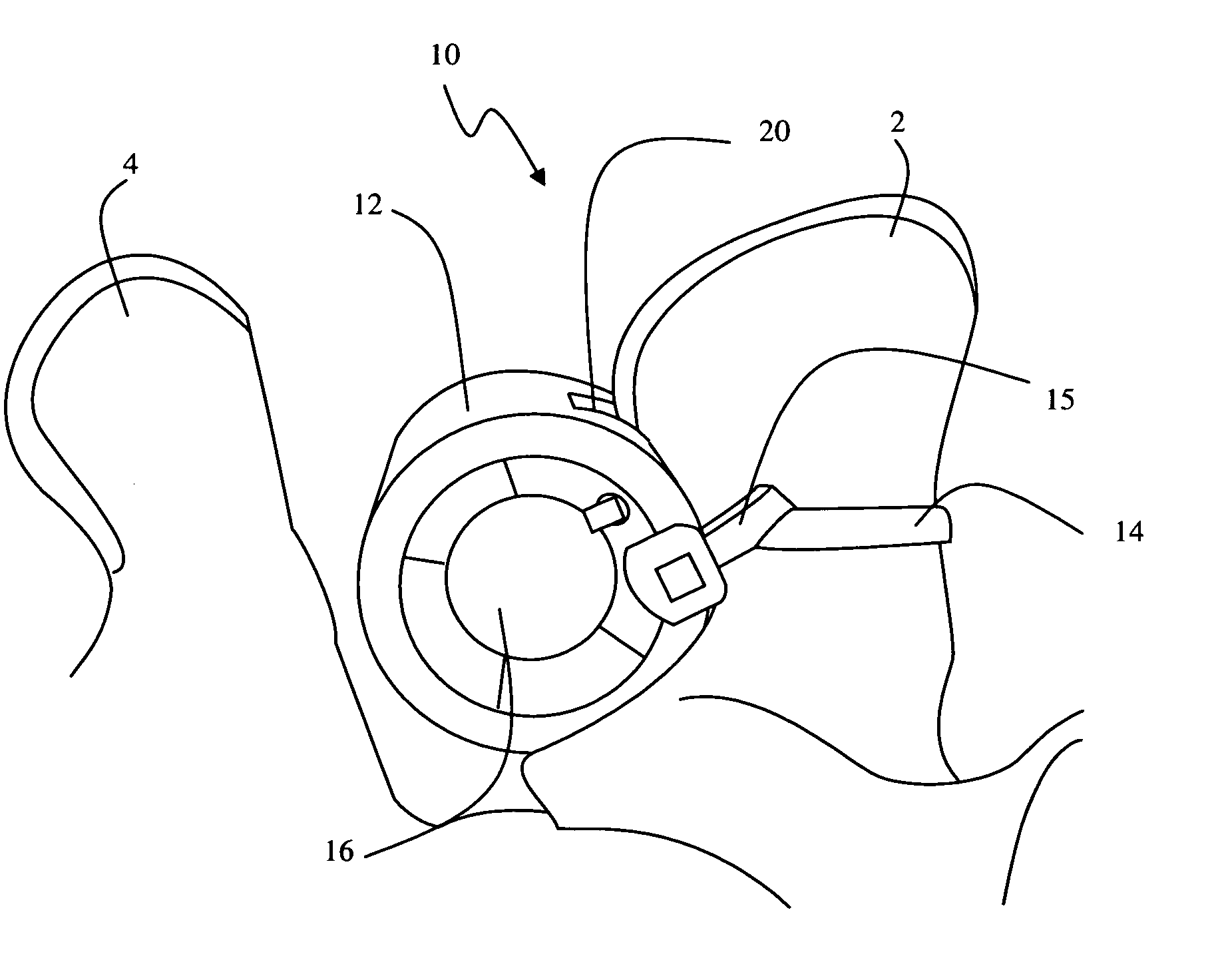 Methods and apparatus for treating spinal stenosis