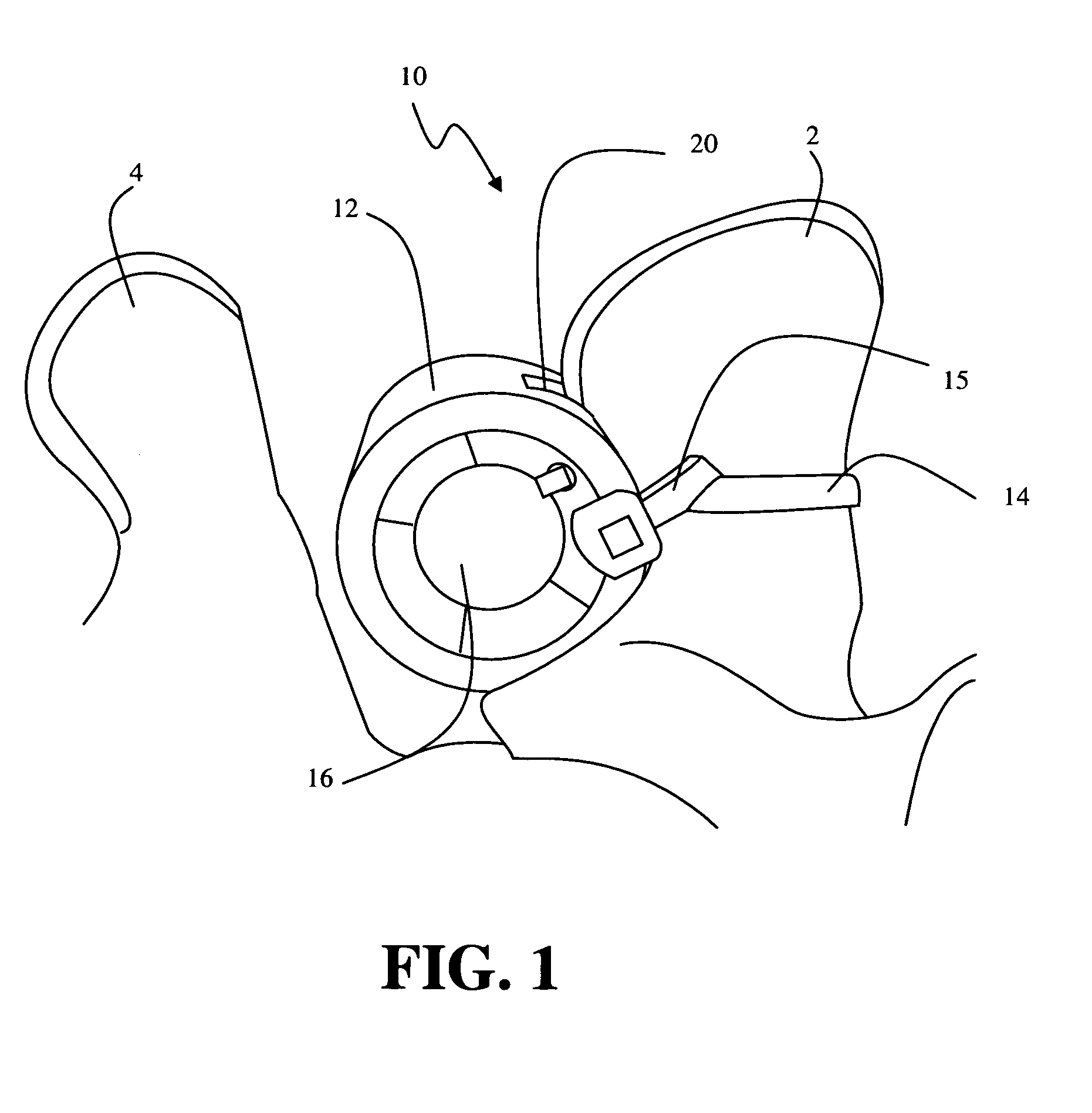 Methods and apparatus for treating spinal stenosis