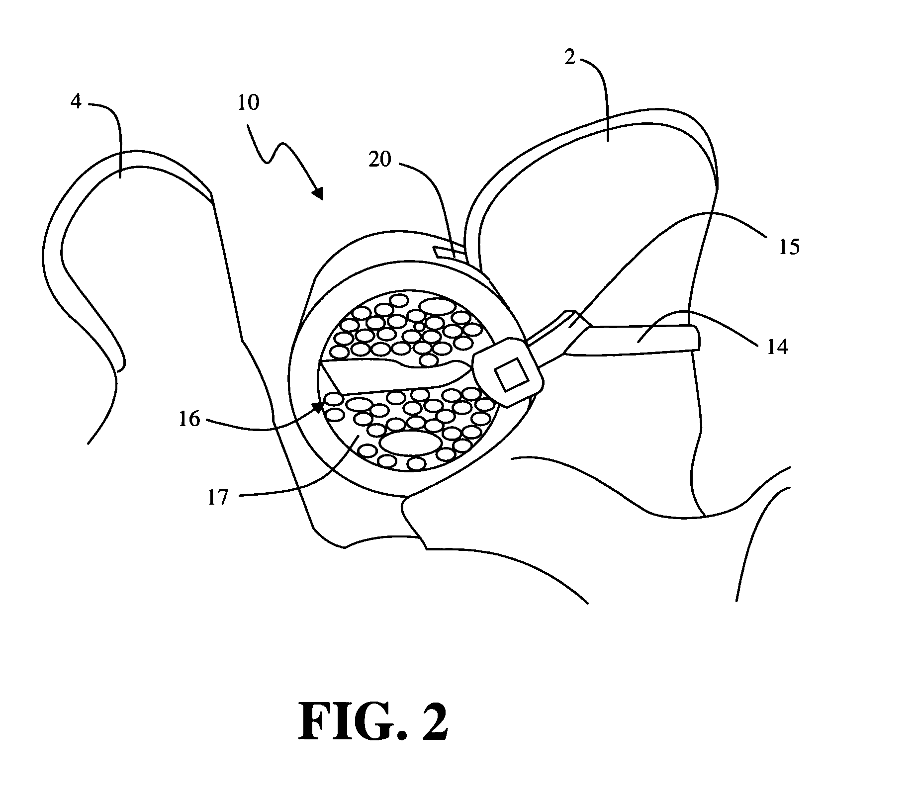 Methods and apparatus for treating spinal stenosis