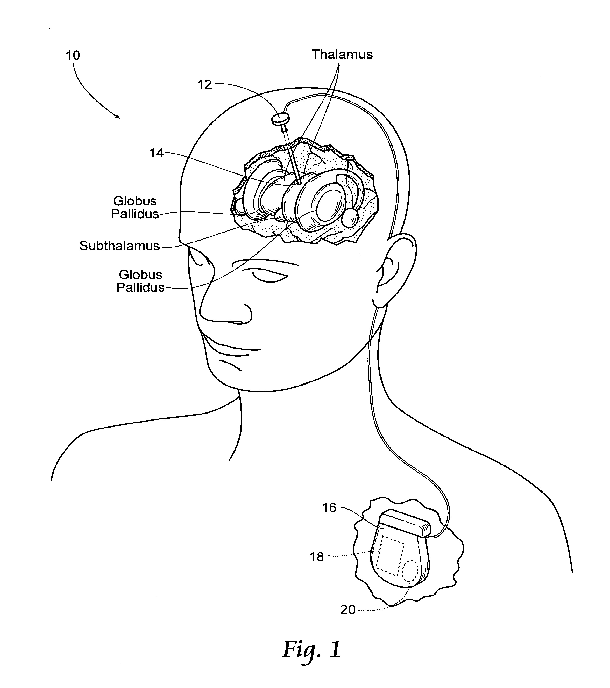 Non-regular electrical stimulation patterns for treating neurological disorders