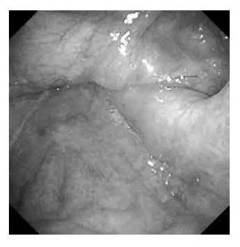 Electronic laryngoscope image classification method based on binuclear convolution feature extraction