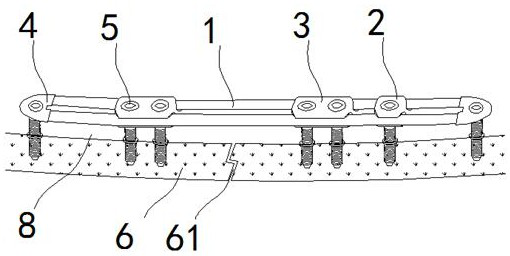 Point contact bridging combination type internal fixation system