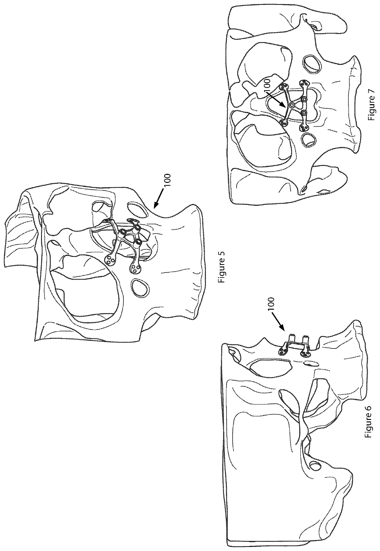 Anchored implant for a nasal prosthesis