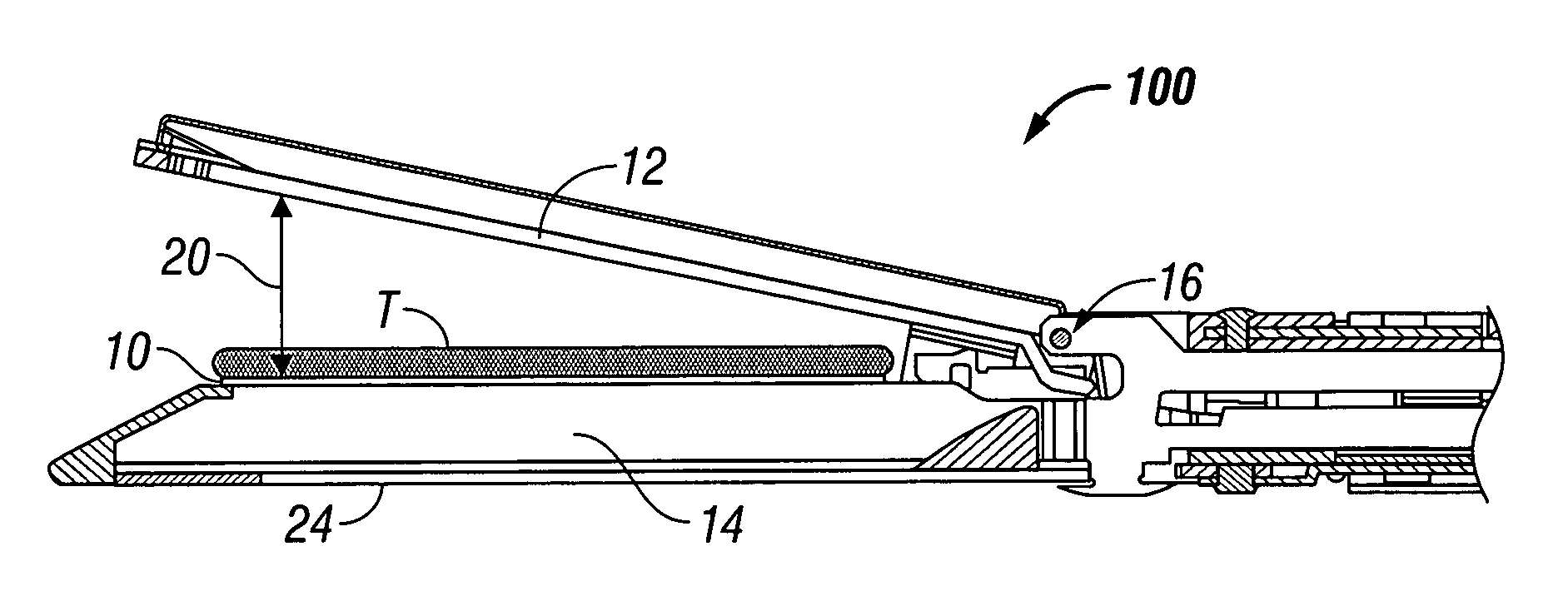 Mechanically tuned buttress material to assist with proper formation of surgical element in diseased tissue