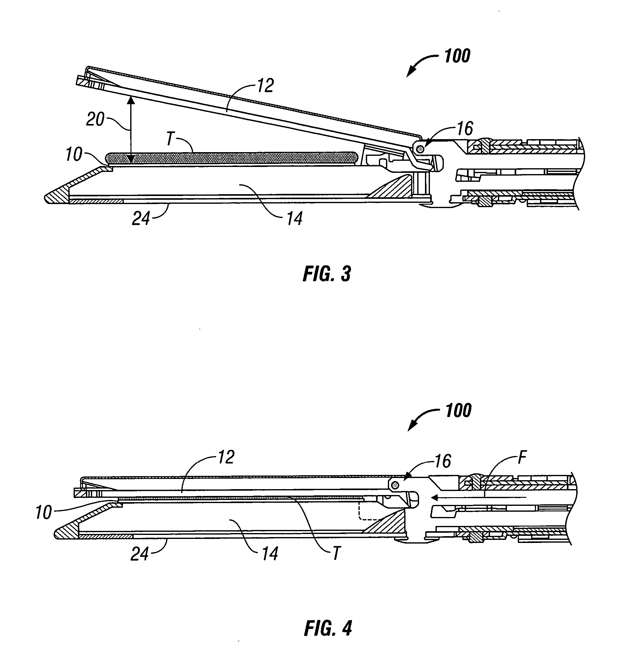 Mechanically tuned buttress material to assist with proper formation of surgical element in diseased tissue