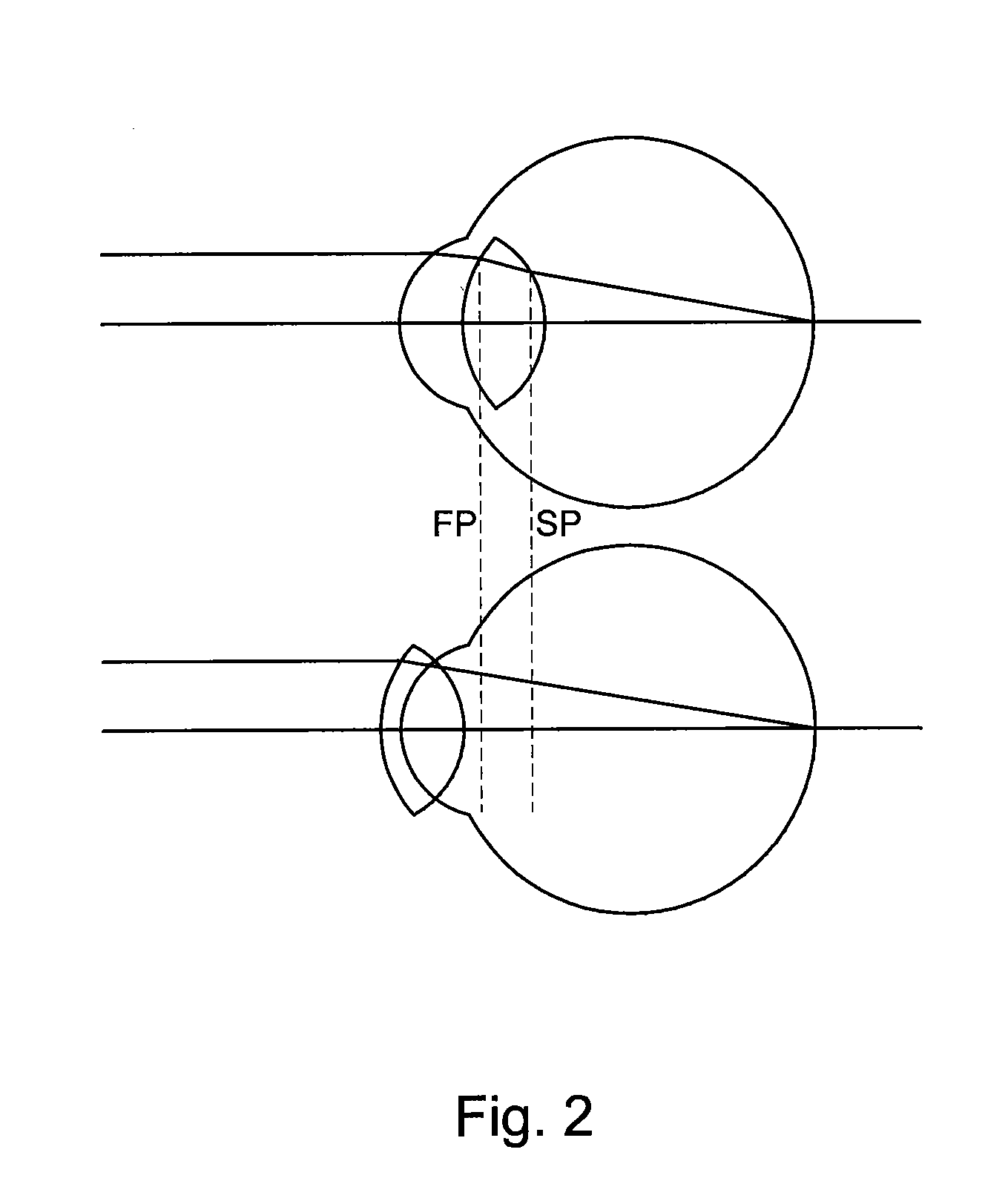 Method of Calculating the Required Power of a Toric Implant