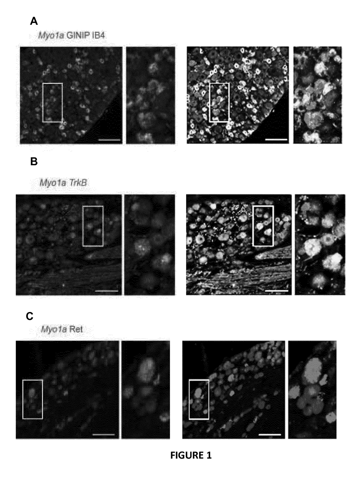 Myo1a for predicting conversion of acute pain into chronic pain and use of myo1a for therapy of pain