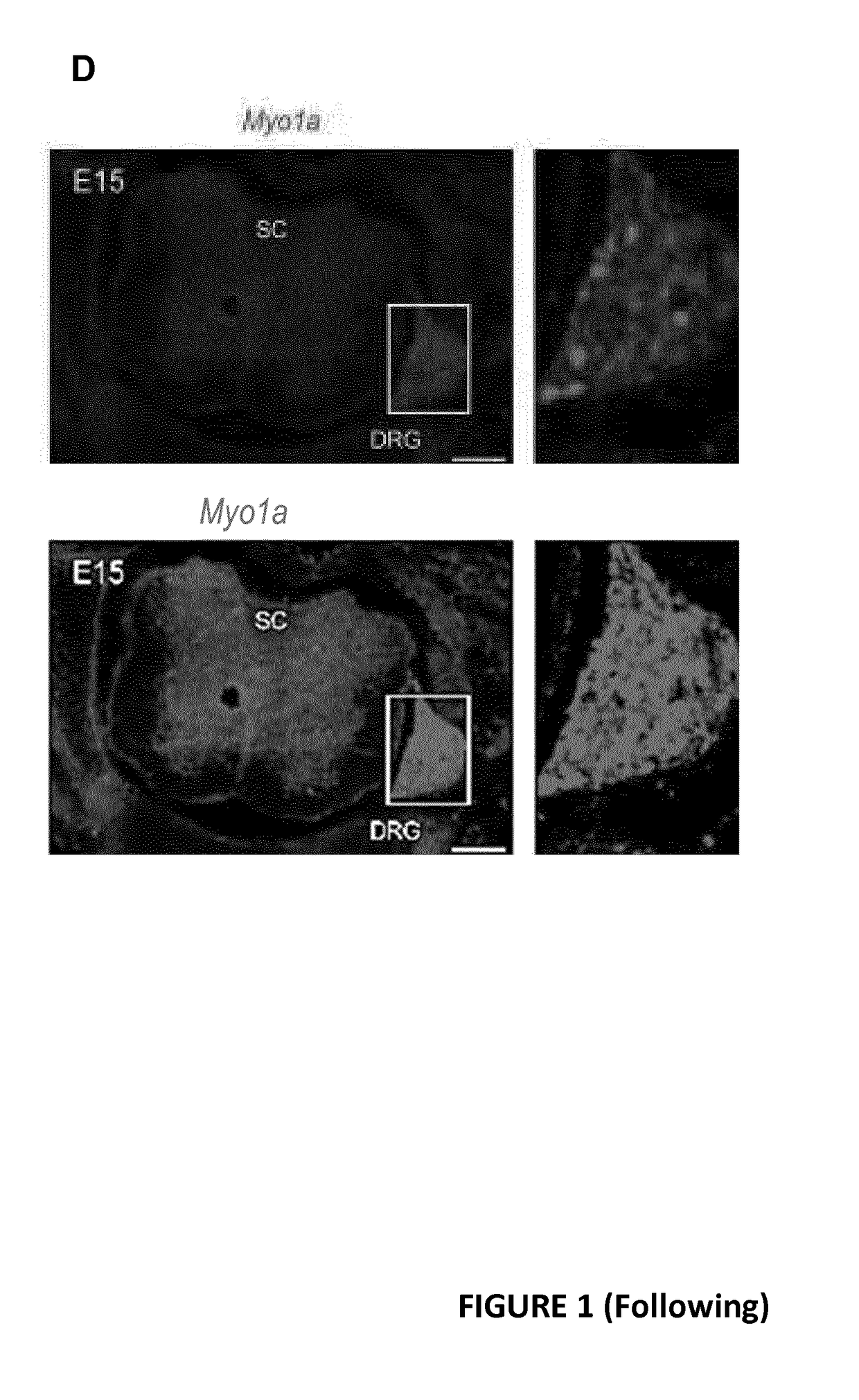 Myo1a for predicting conversion of acute pain into chronic pain and use of myo1a for therapy of pain