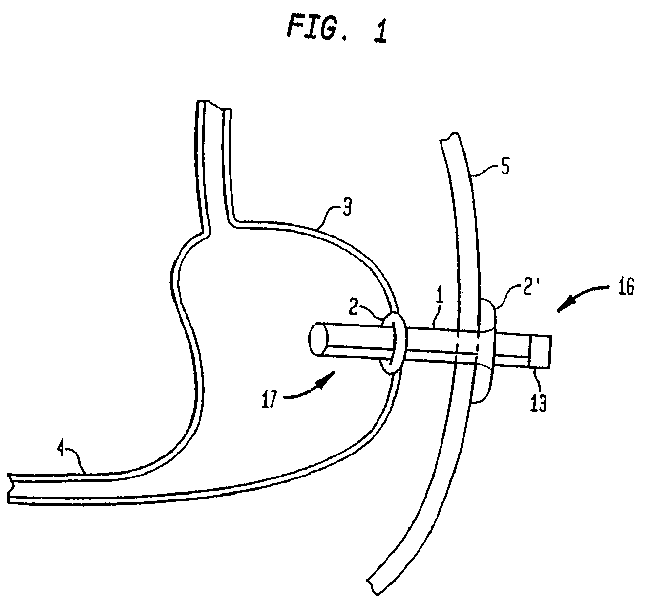 Externally reinforced percutaneous gastrostomy tube with customizable smooth tube length