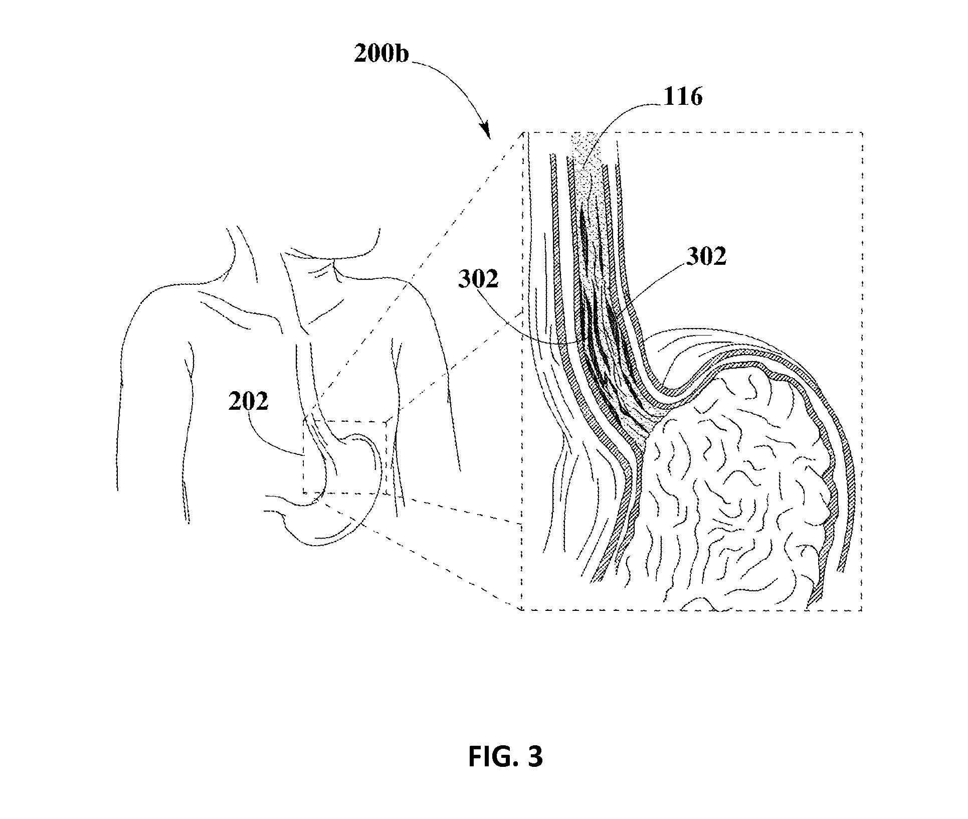 Methods and Compositions for Treating Esophageal Diseases