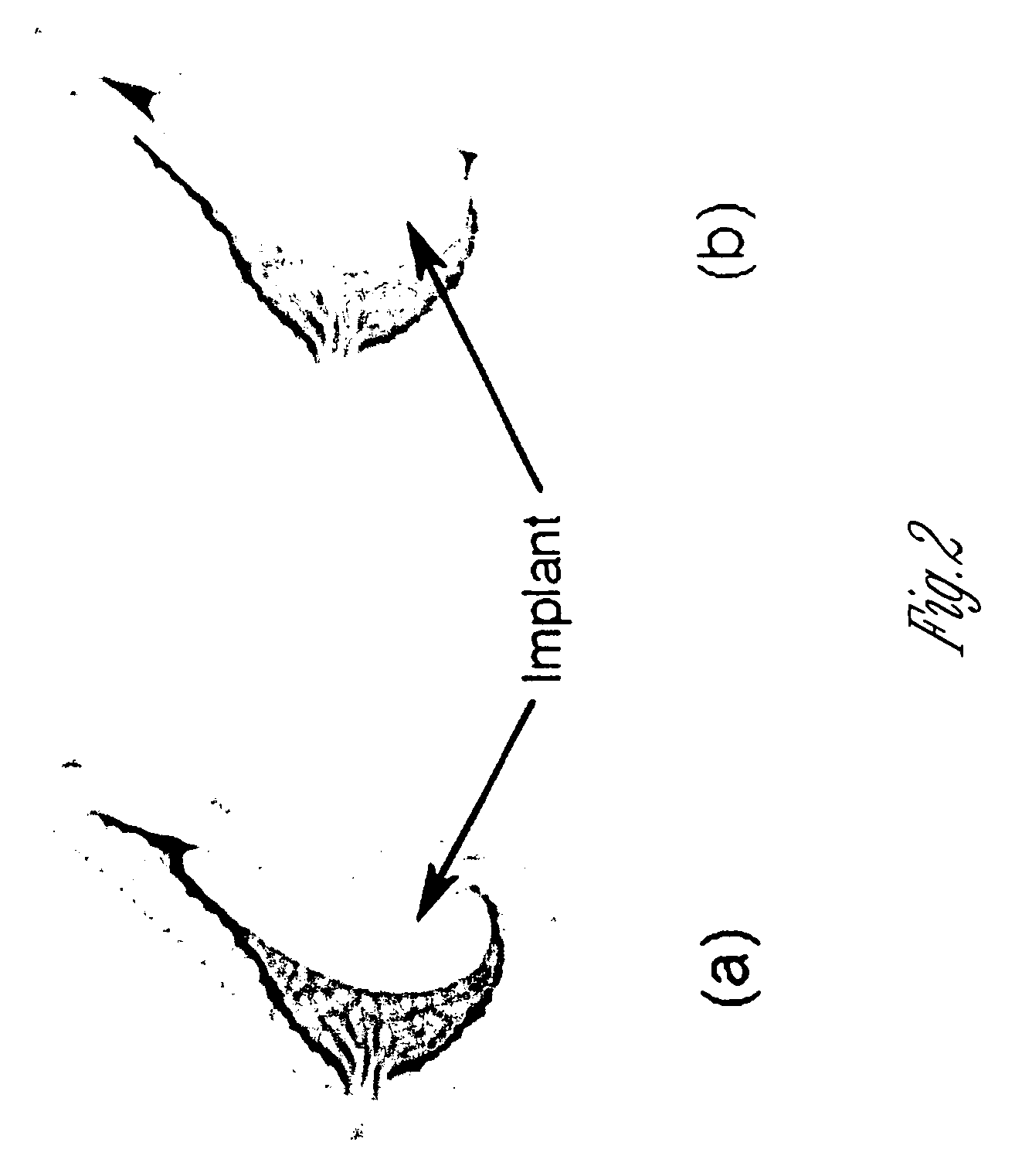 Compositions for breast implant filling and methods of use