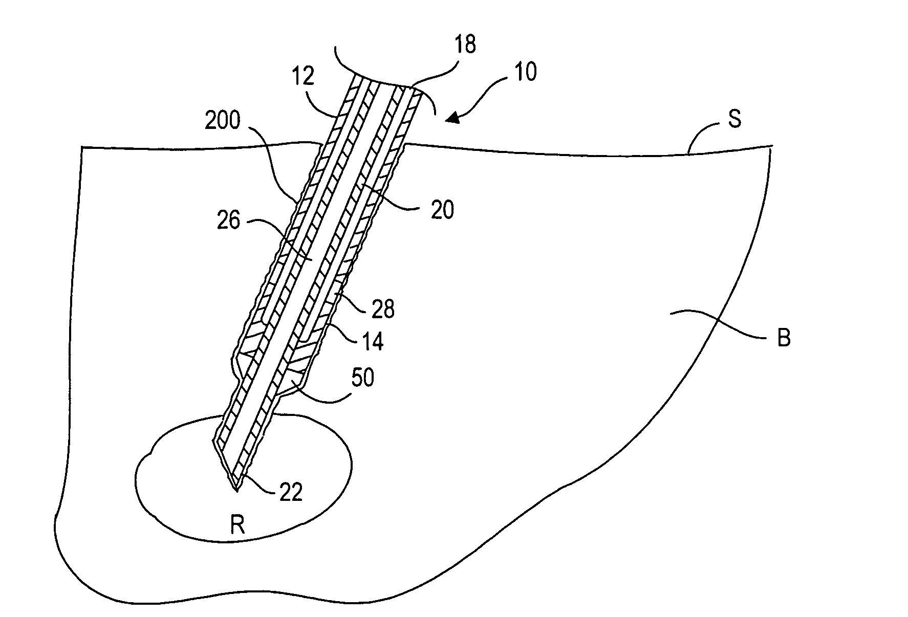 Devices and methods for delivering therapeutic or diagnostic agents