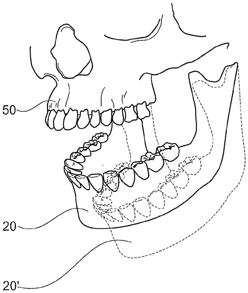 Method for detecting movement of temporomandibular joint