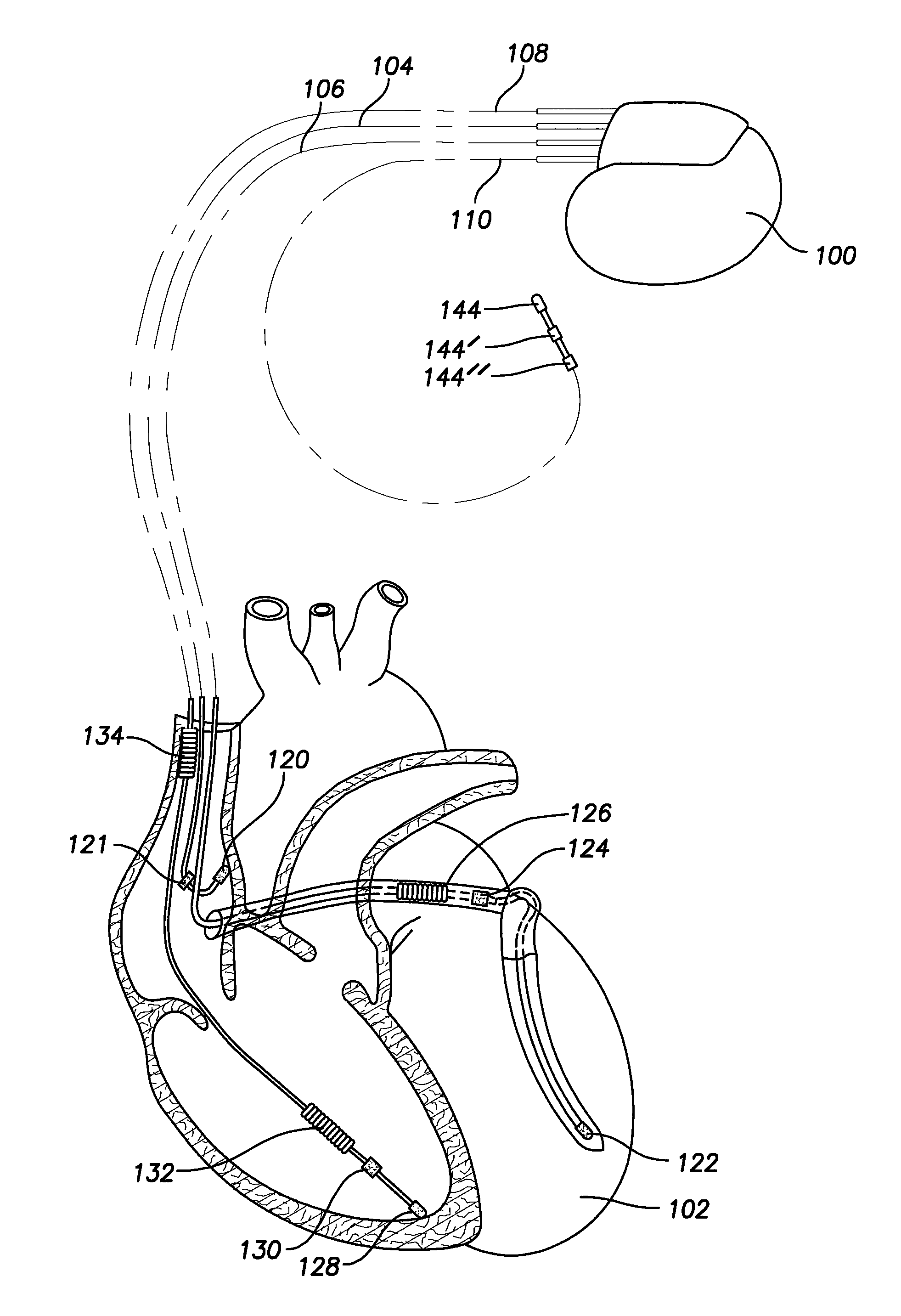 Small caliber implantable biometric leads and cables for same