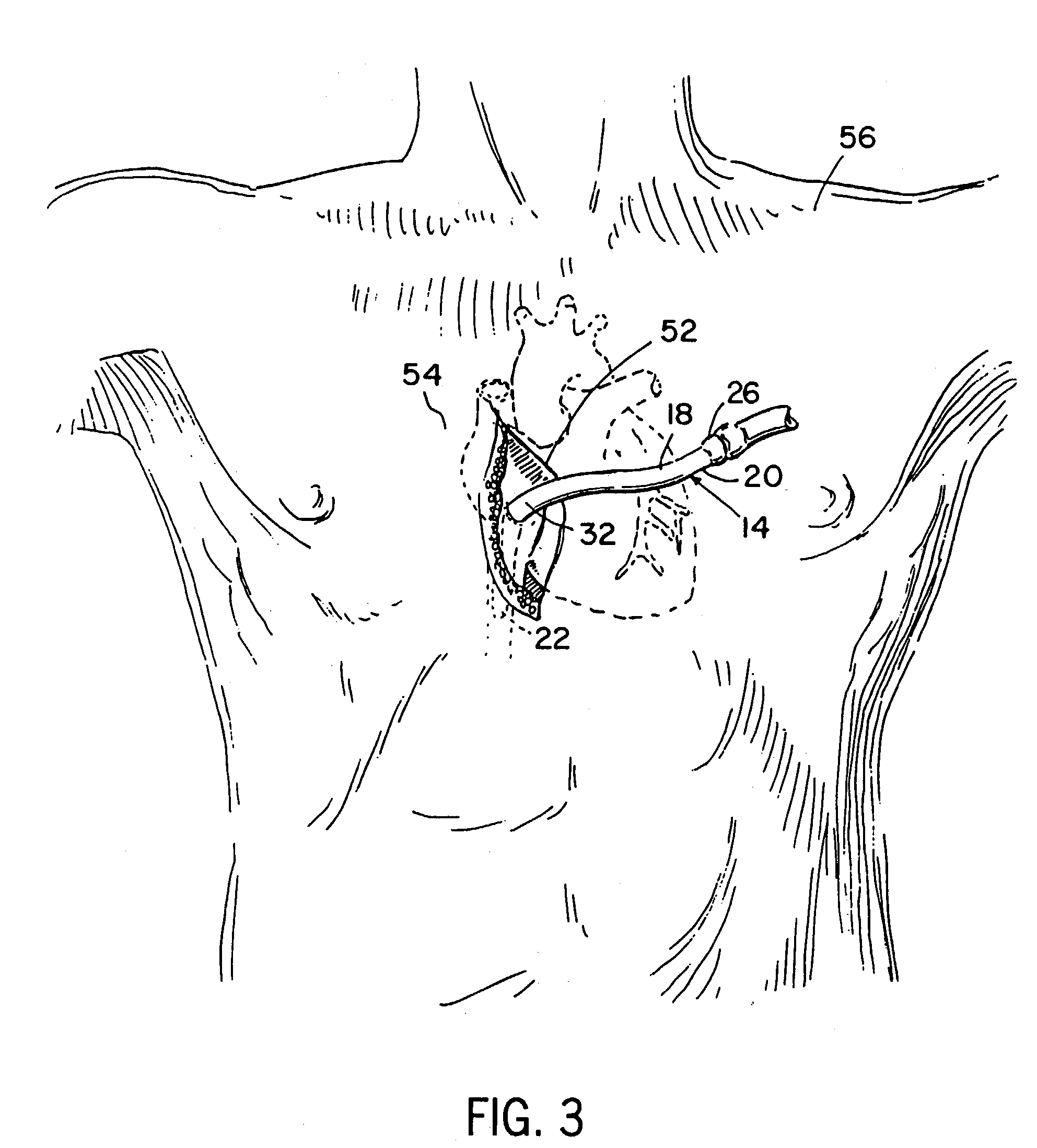 Oval-shaped cardiac cannula