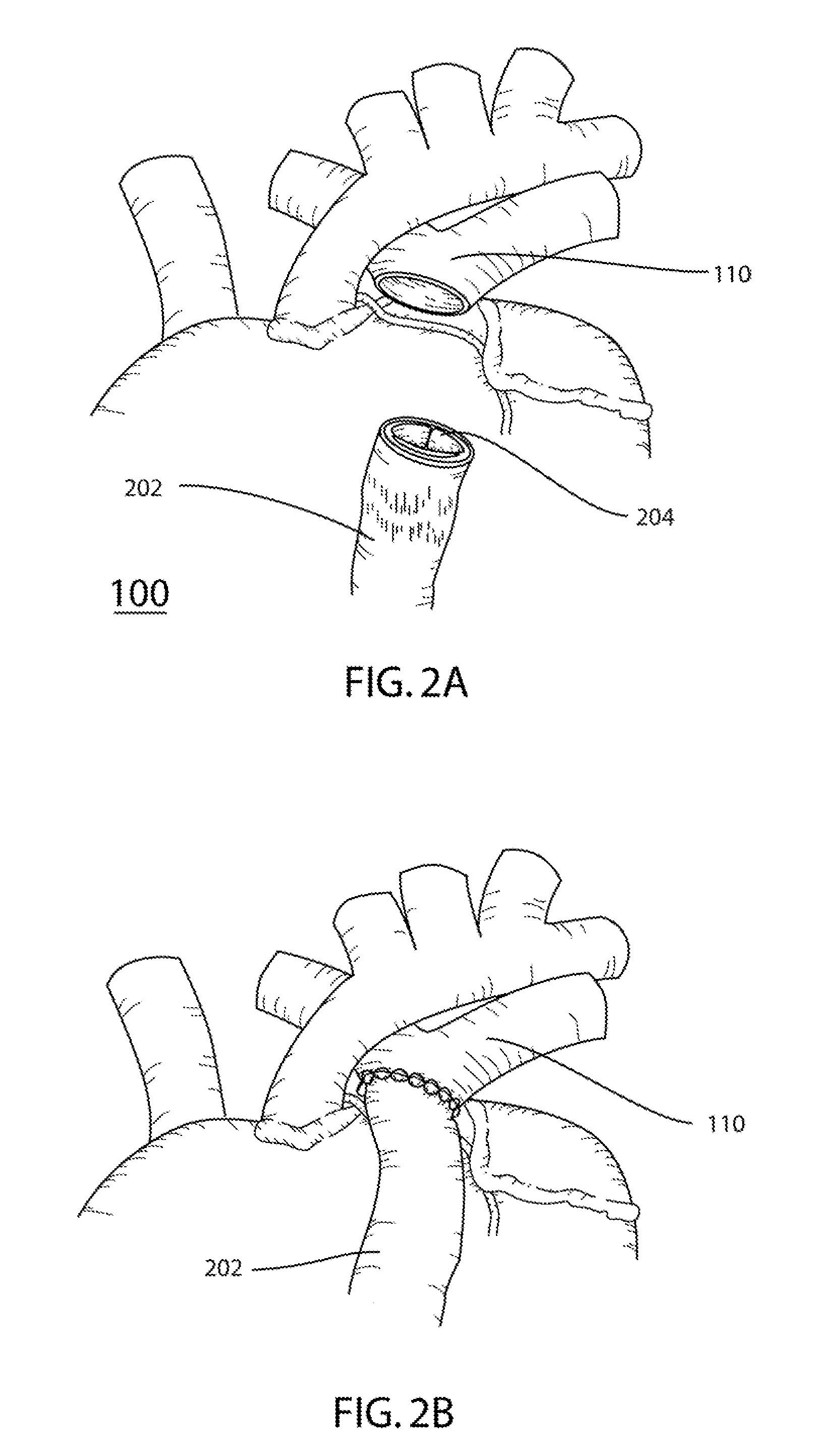 Prosthetic Conduit With Radiopaque Symmetry Indicators