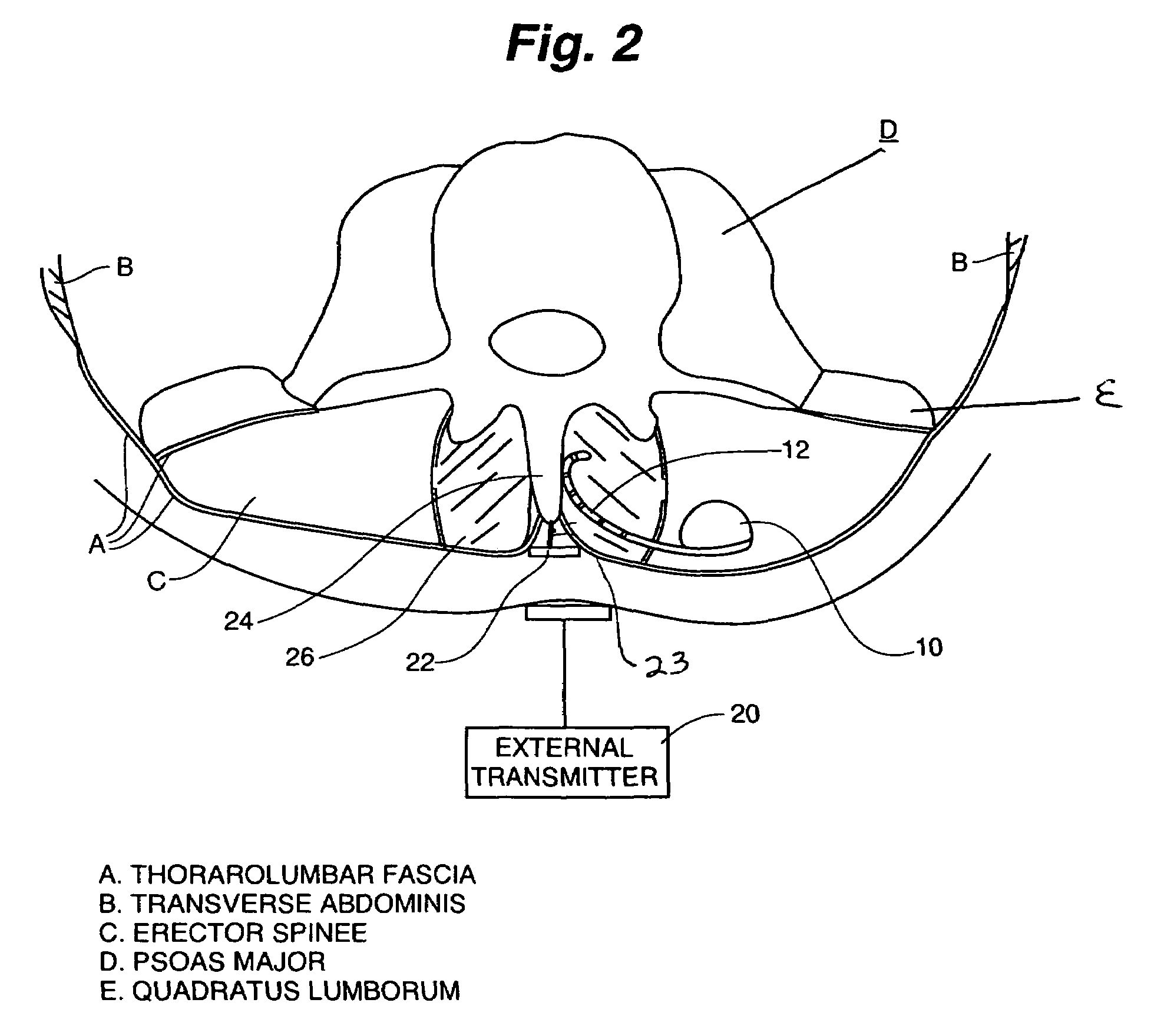 Muscle stimulator