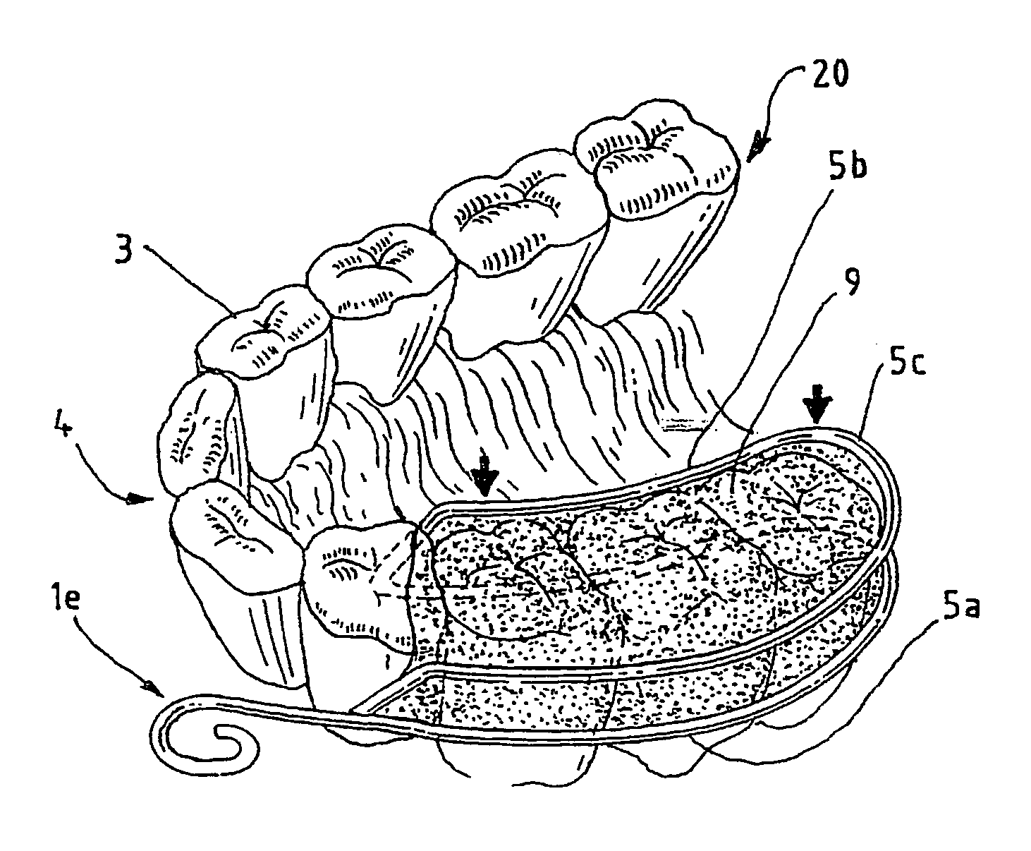 Dental impression method and device