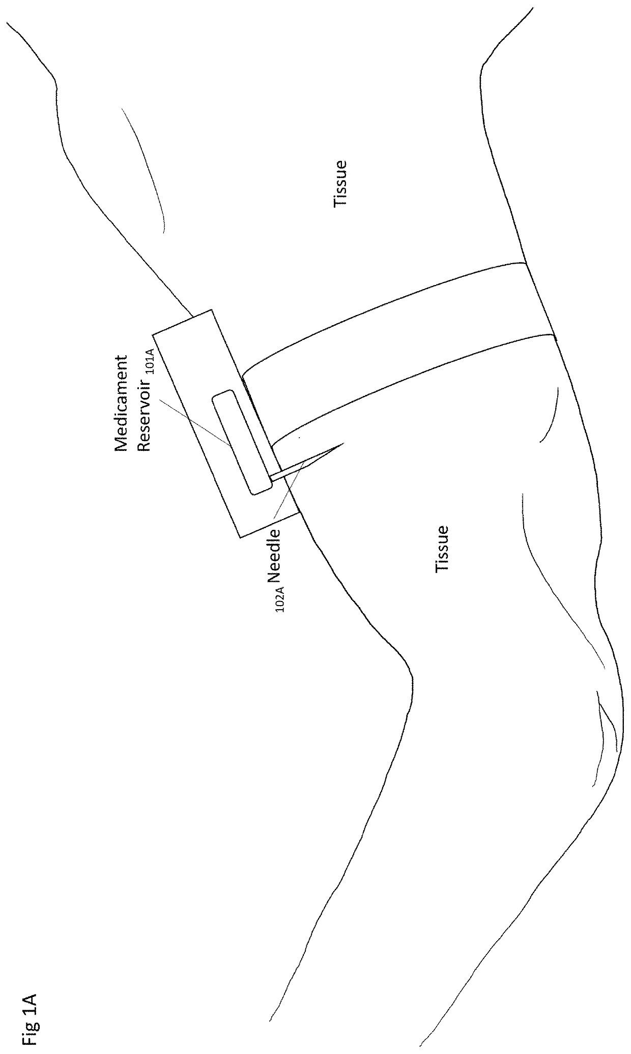 Systems and method for detection and treatment of opioid overdose