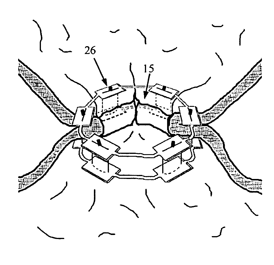 Endoluminal gastric ring and method