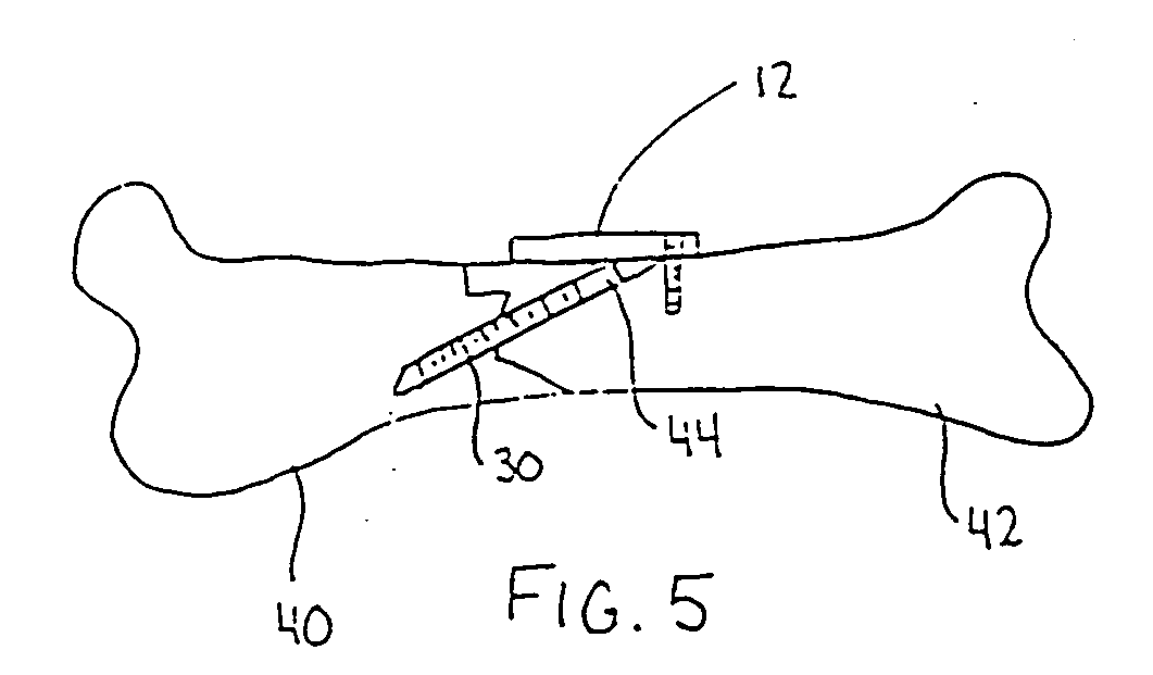 Implant retaining device