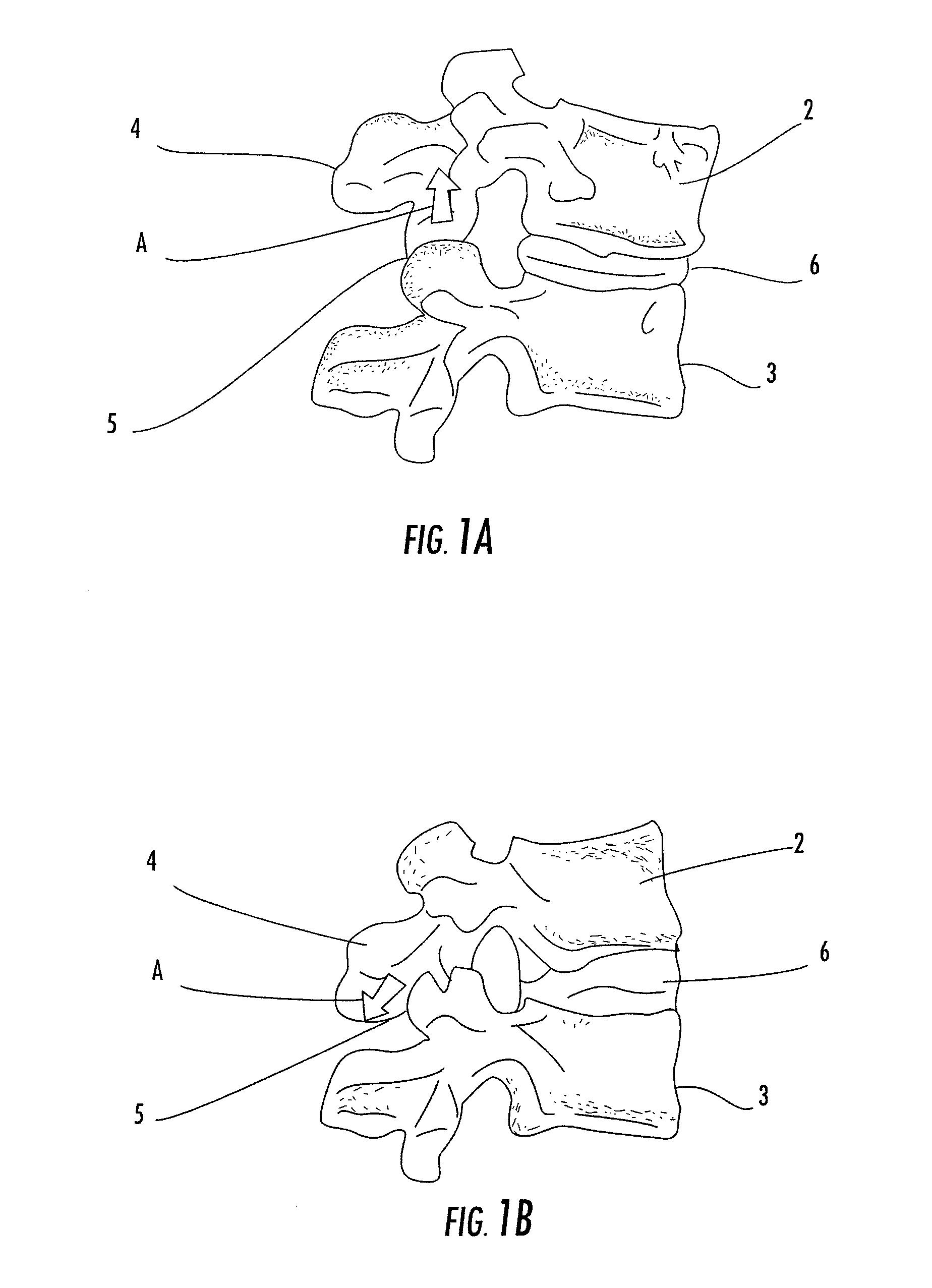 Connecting rod for bone anchors having a bioresorbable tip