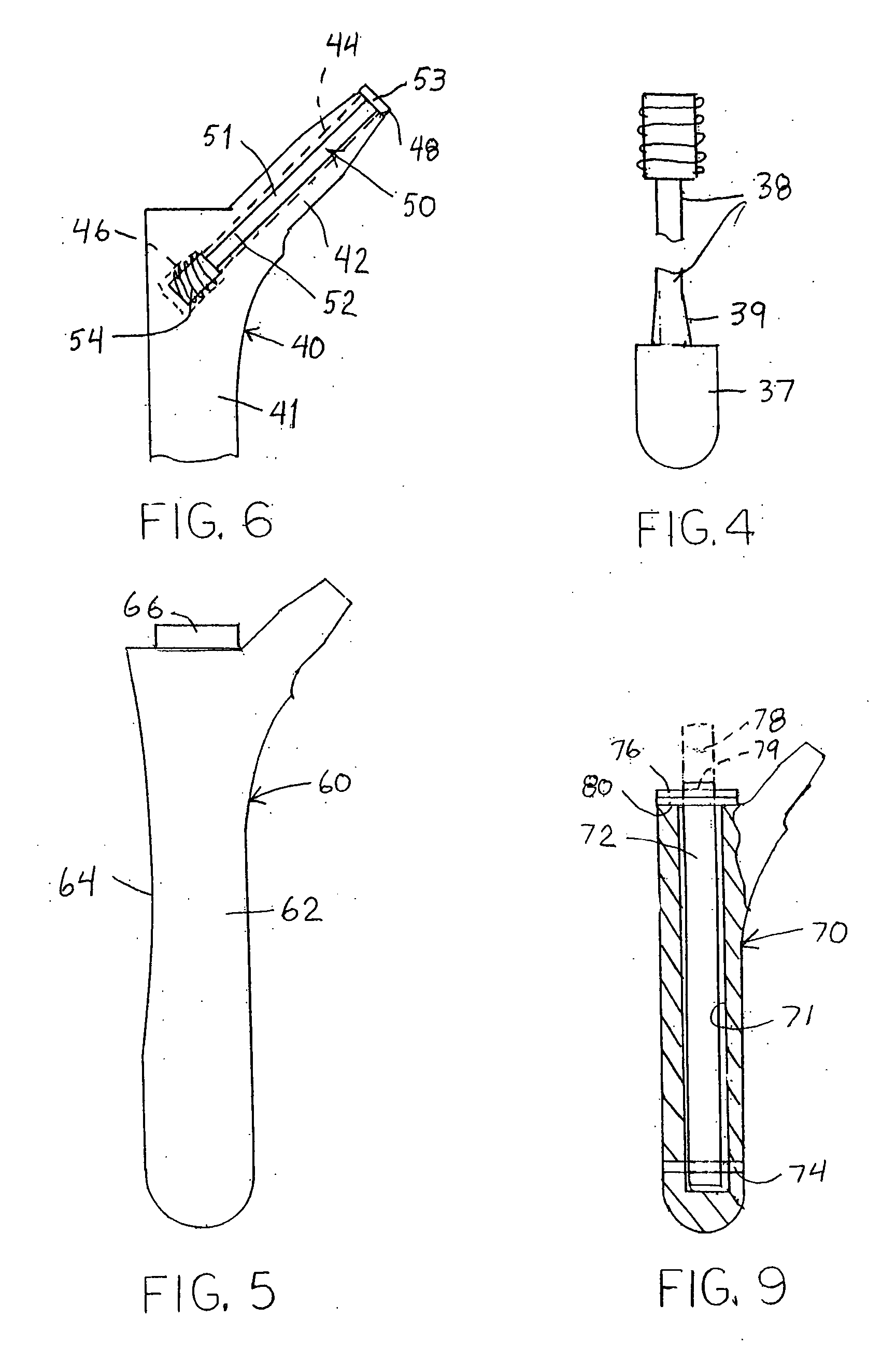 Pre-stressed implant