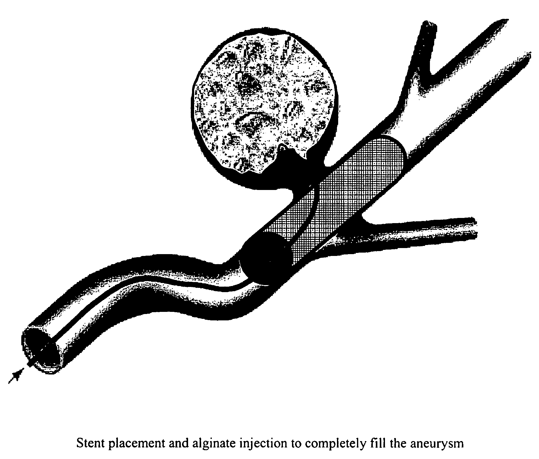 Compositions and methods for improved occlusion of vascular defects