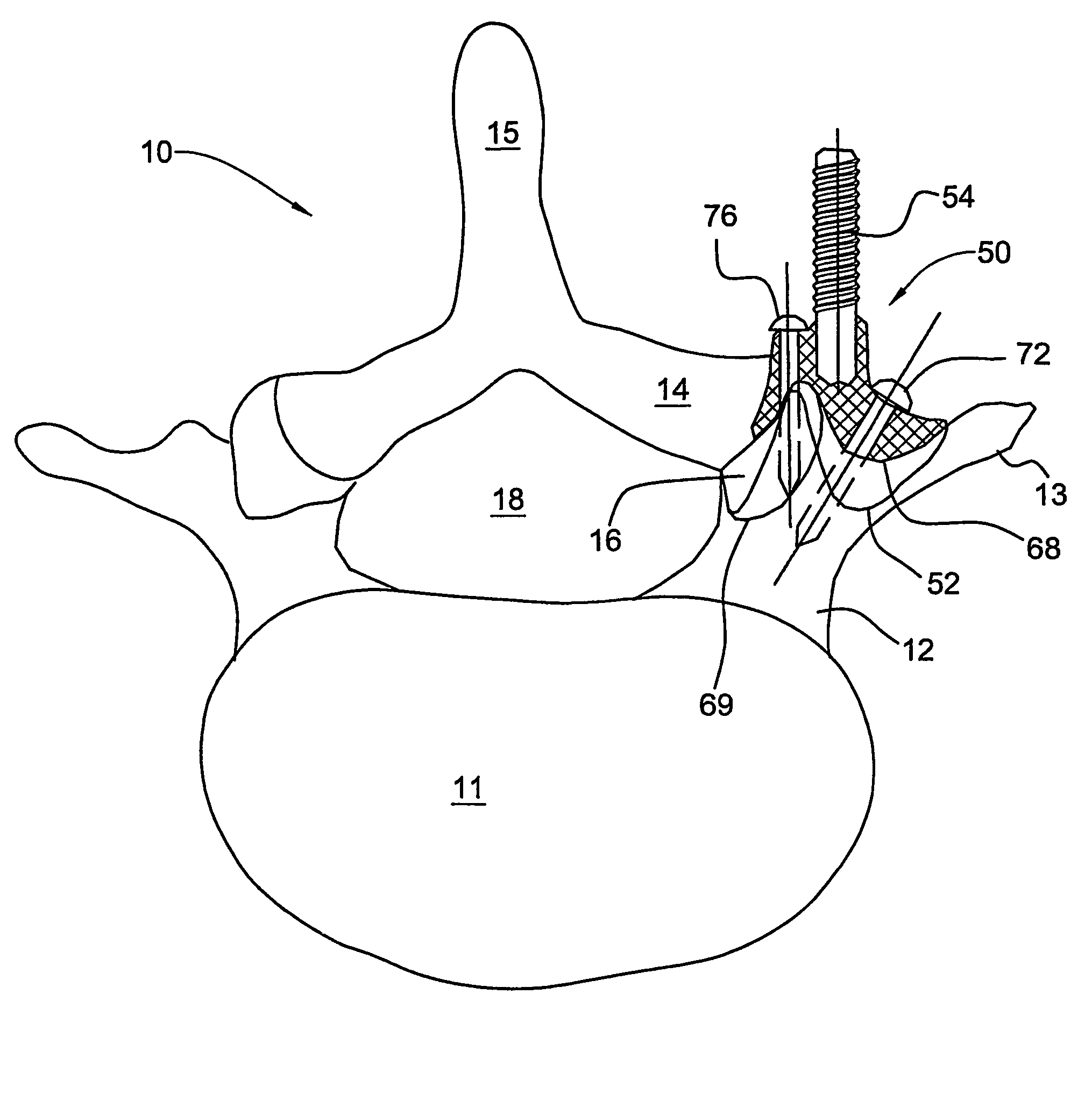 Orthopedic clamps