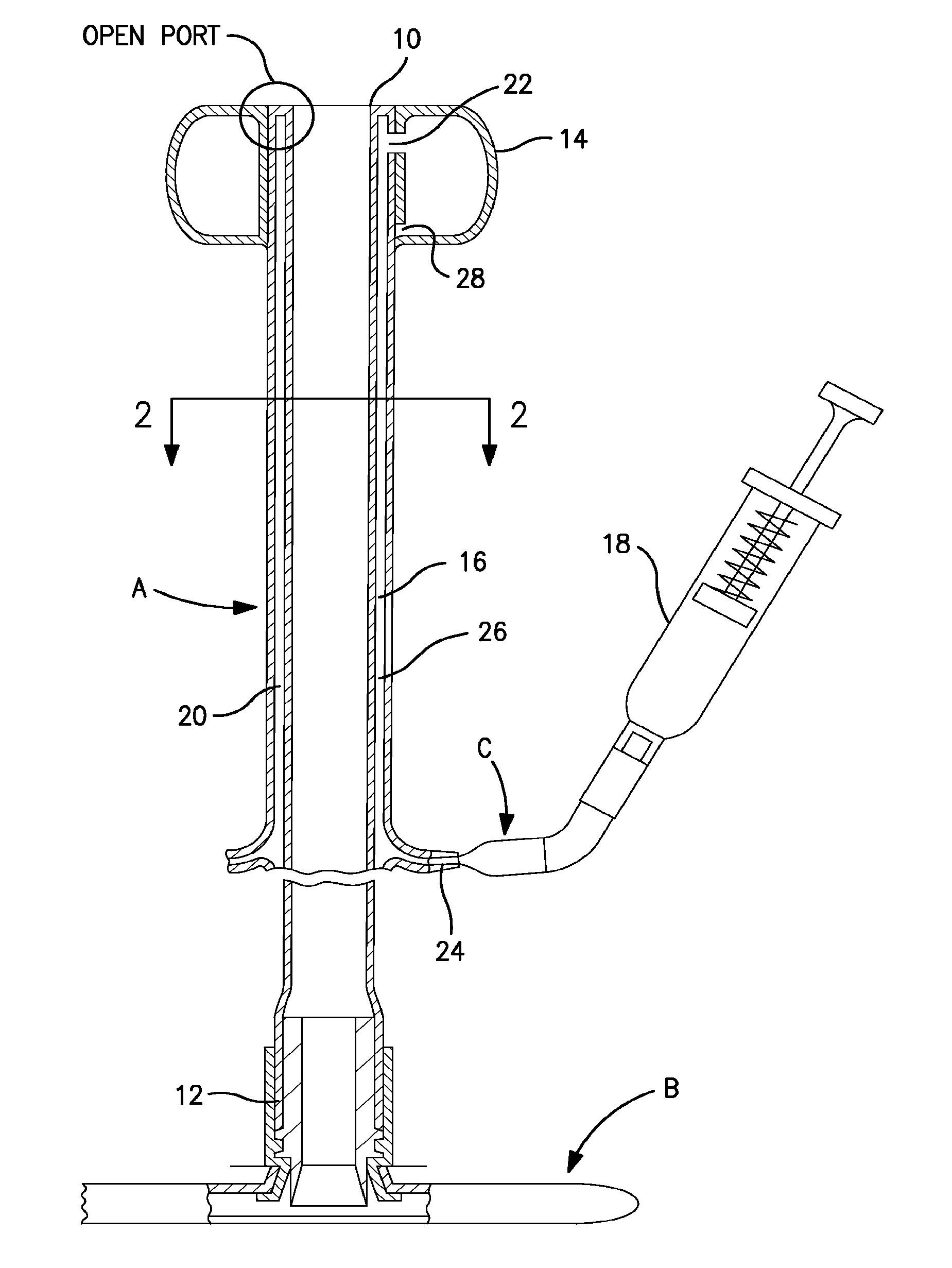 Apparatus for preventing over inflation of the retention balloon in medical catheters and airway devices